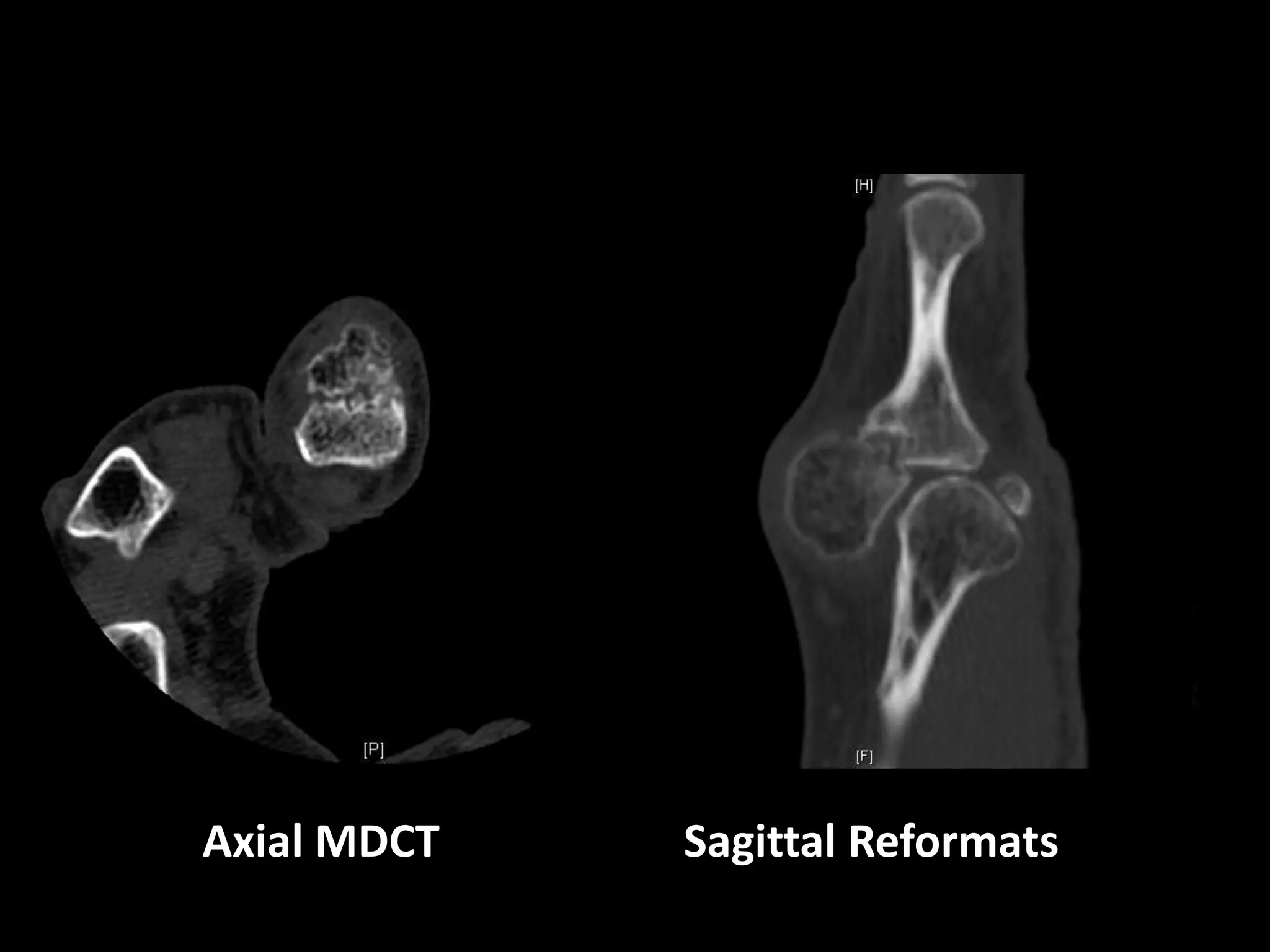 Axial MDCT Sagittal Reformats
 