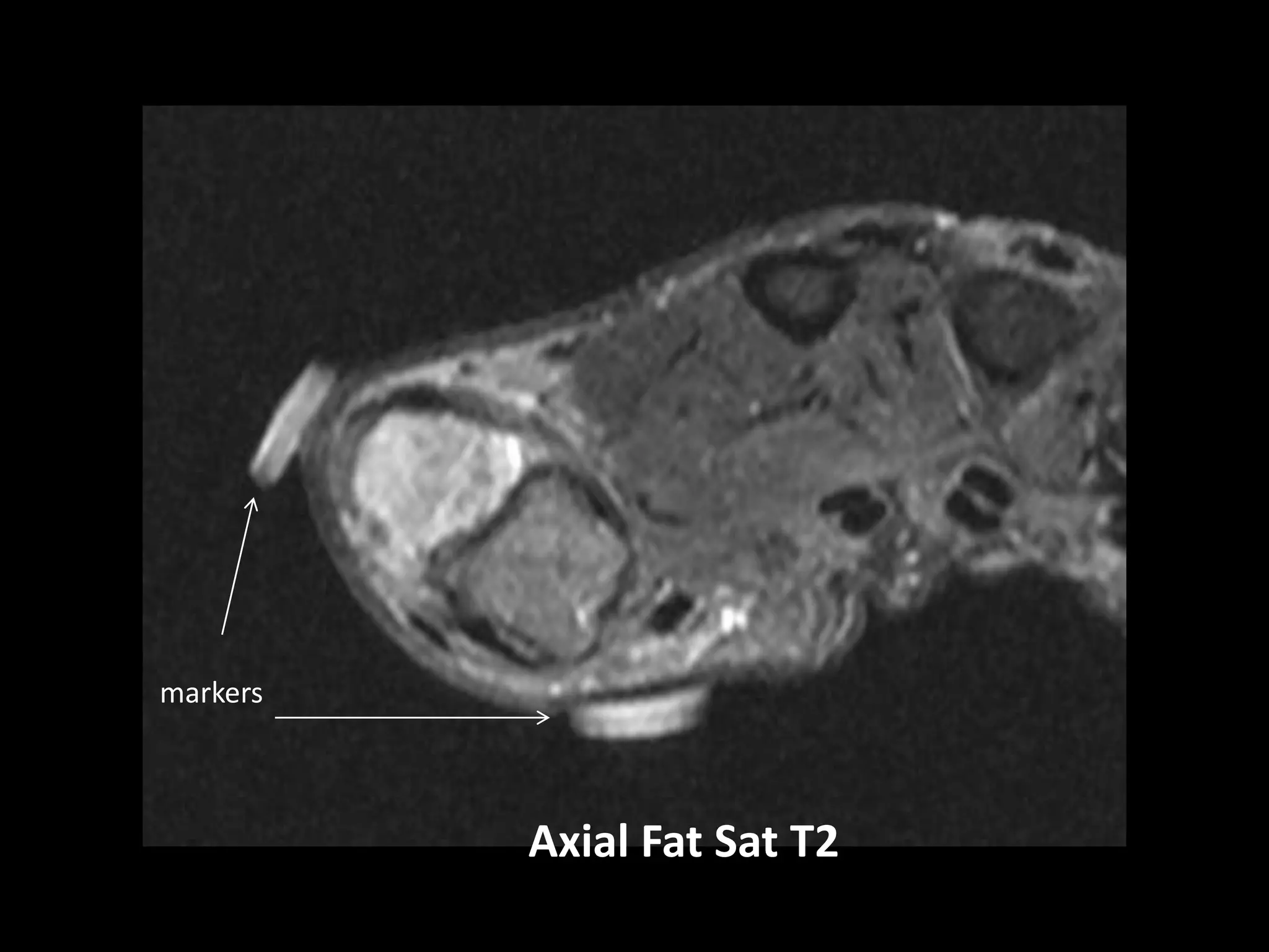 Axial Fat Sat T2
markers
 