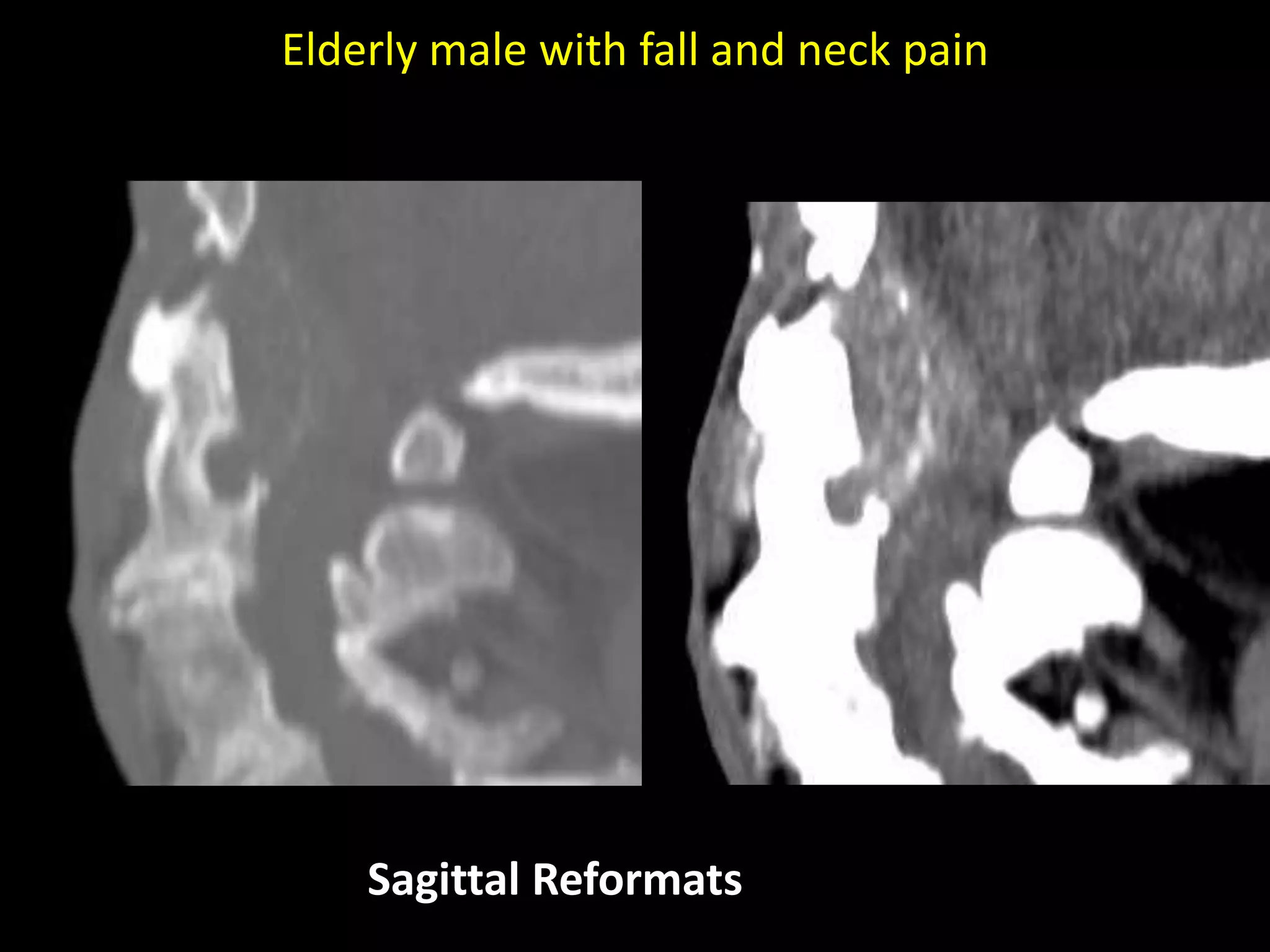 Elderly male with fall and neck pain
Sagittal Reformats
 