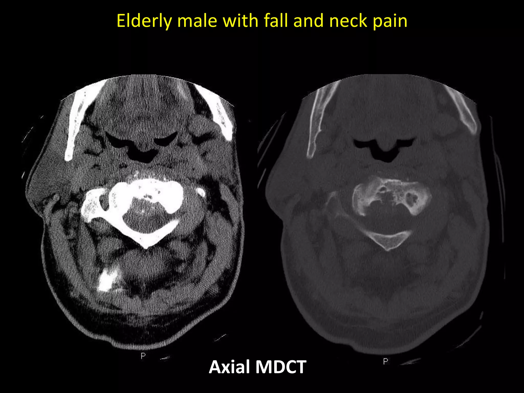 Elderly male with fall and neck pain
Axial MDCT
 