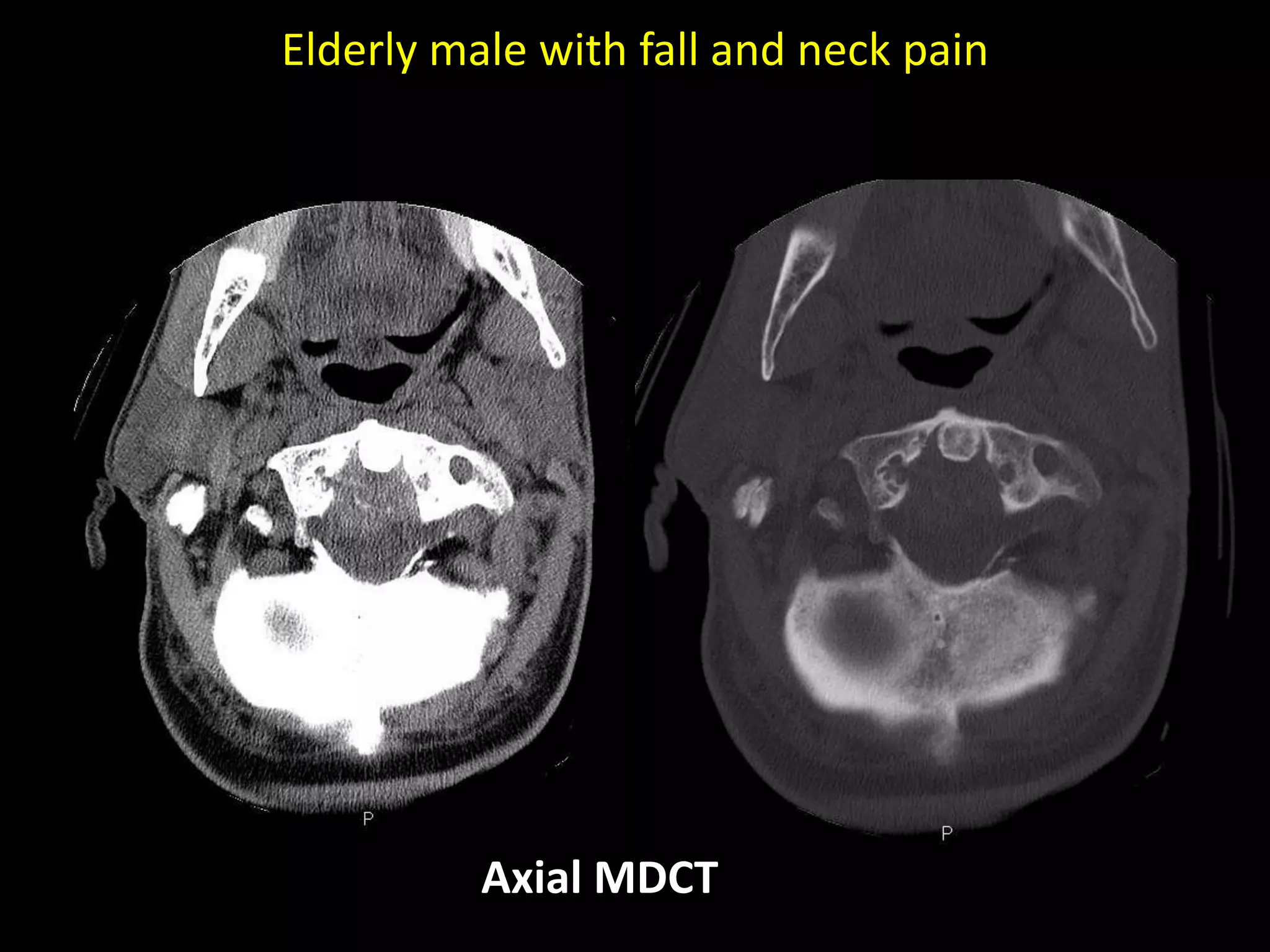 Elderly male with fall and neck pain
Axial MDCT
 