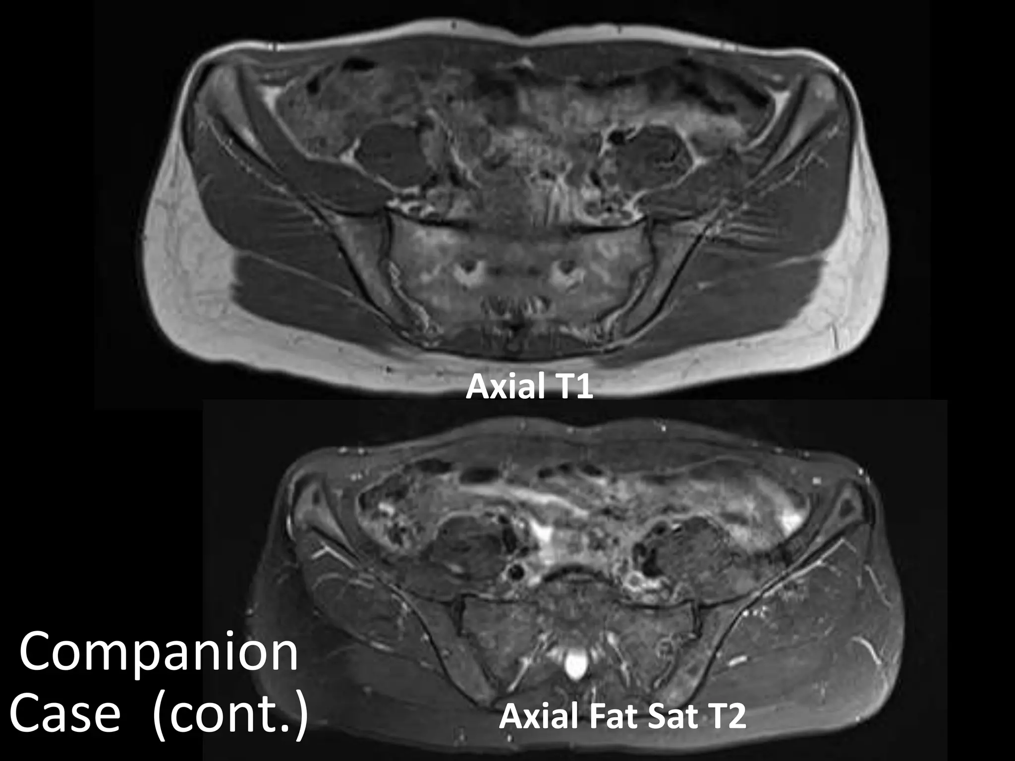Axial T1
Companion
Case (cont.) Axial Fat Sat T2
 