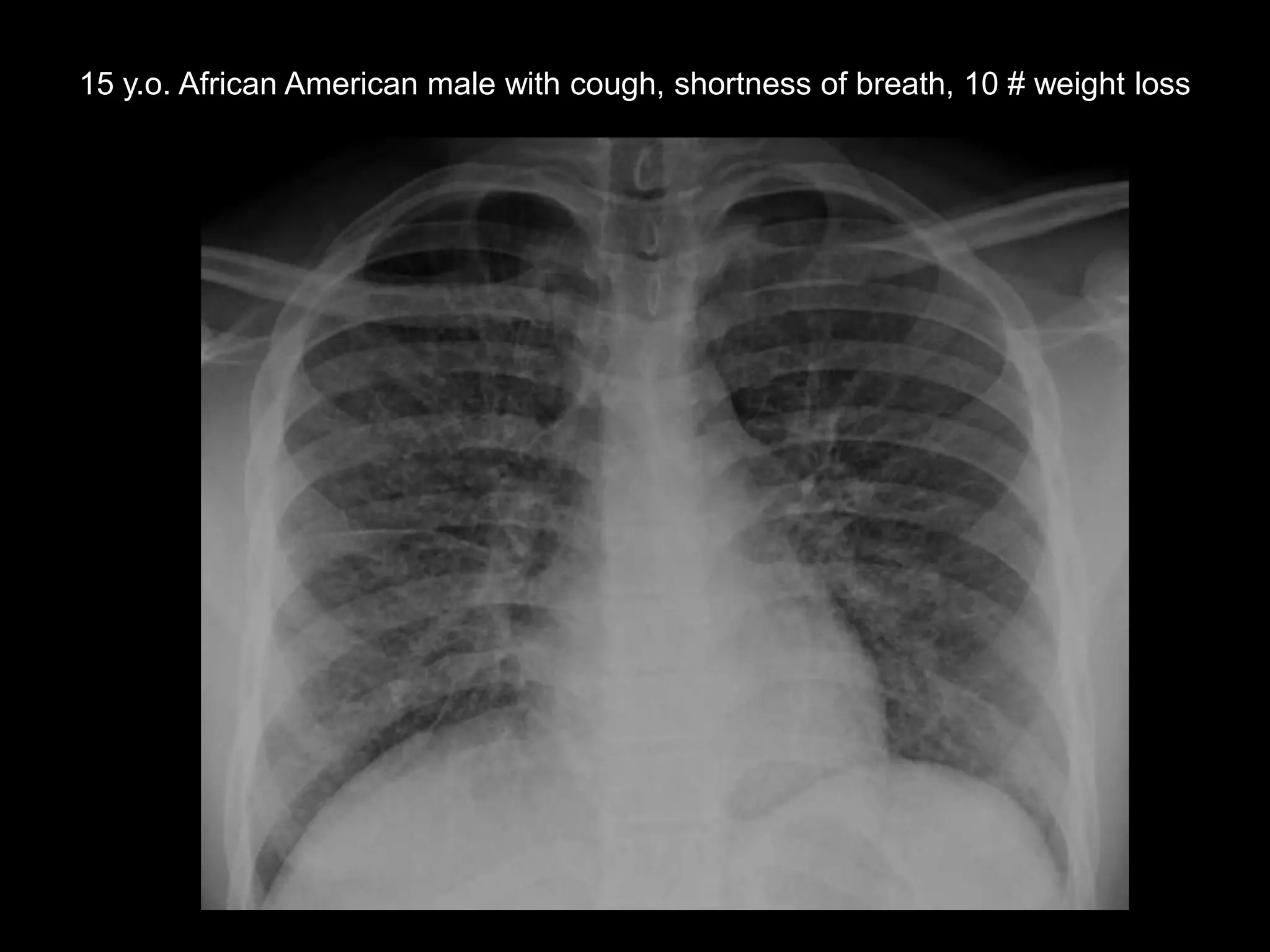 15 y.o. African American male with cough, shortness of breath, 10 # weight loss

 