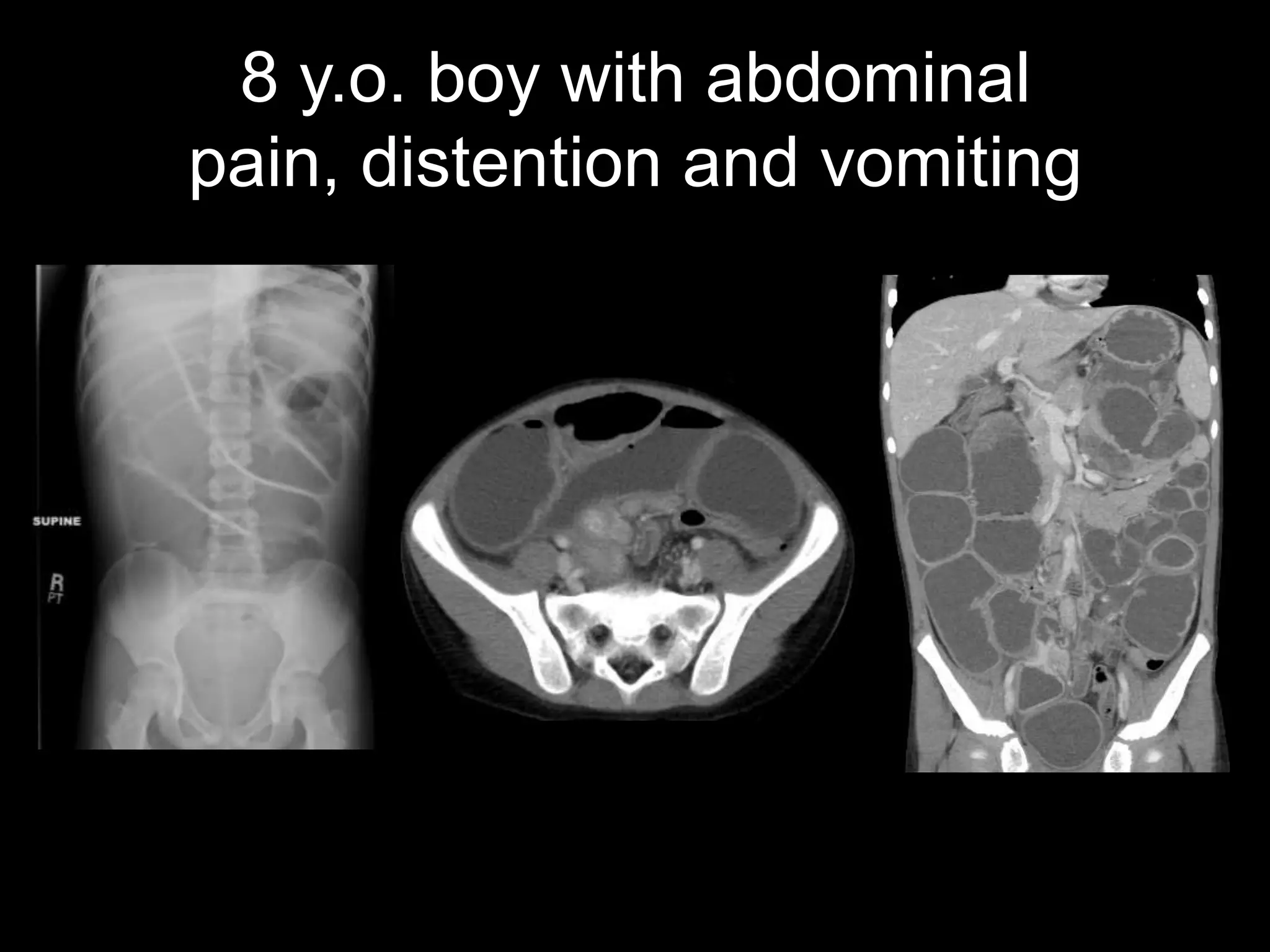 8 y.o. boy with abdominal
pain, distention and vomiting

 