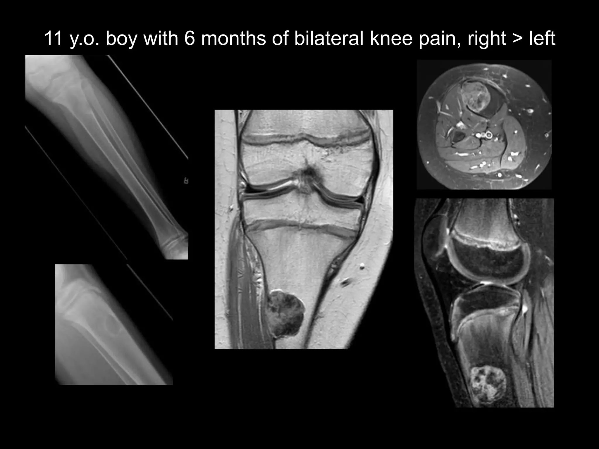 11 y.o. boy with 6 months of bilateral knee pain, right > left

 