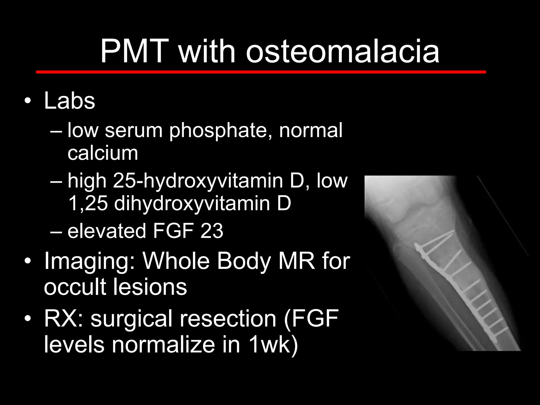 PMT with osteomalacia
• Labs
– low serum phosphate, normal
calcium
– high 25-hydroxyvitamin D, low
1,25 dihydroxyvitamin D
– elevated FGF 23

• Imaging: Whole Body MR for
occult lesions
• RX: surgical resection (FGF
levels normalize in 1wk)

 