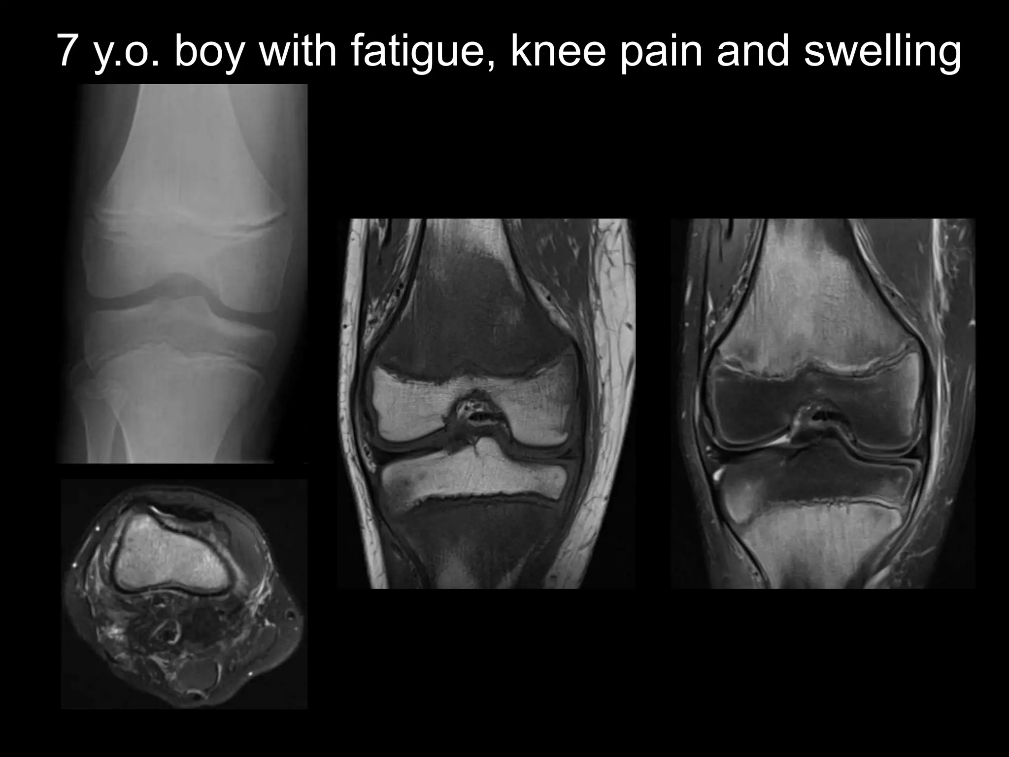 7 y.o. boy with fatigue, knee pain and swelling

 