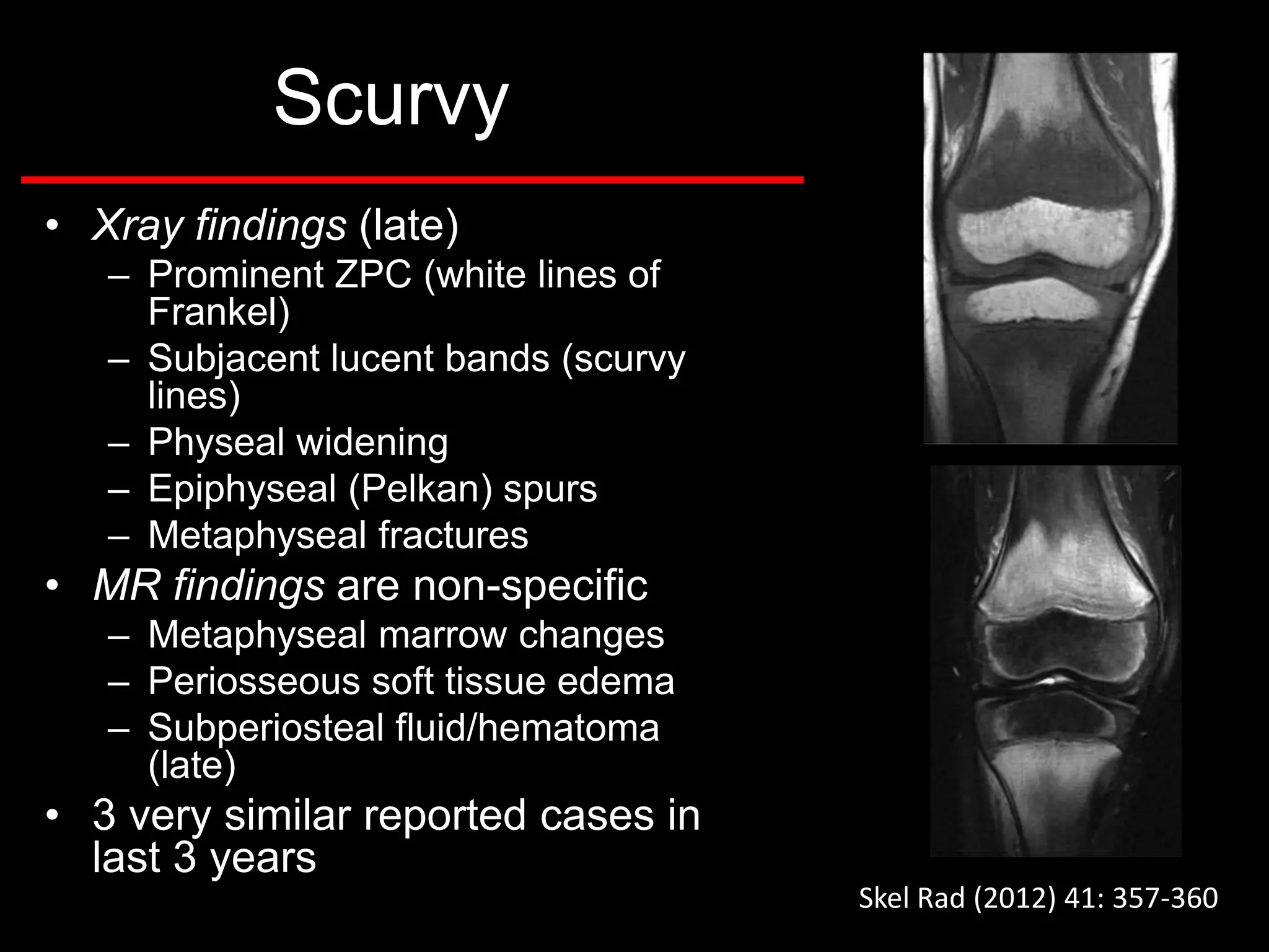 Scurvy
• Xray findings (late)
– Prominent ZPC (white lines of
Frankel)
– Subjacent lucent bands (scurvy
lines)
– Physeal widening
– Epiphyseal (Pelkan) spurs
– Metaphyseal fractures

• MR findings are non-specific
– Metaphyseal marrow changes
– Periosseous soft tissue edema
– Subperiosteal fluid/hematoma
(late)

• 3 very similar reported cases in
last 3 years
Skel Rad (2012) 41: 357-360

 