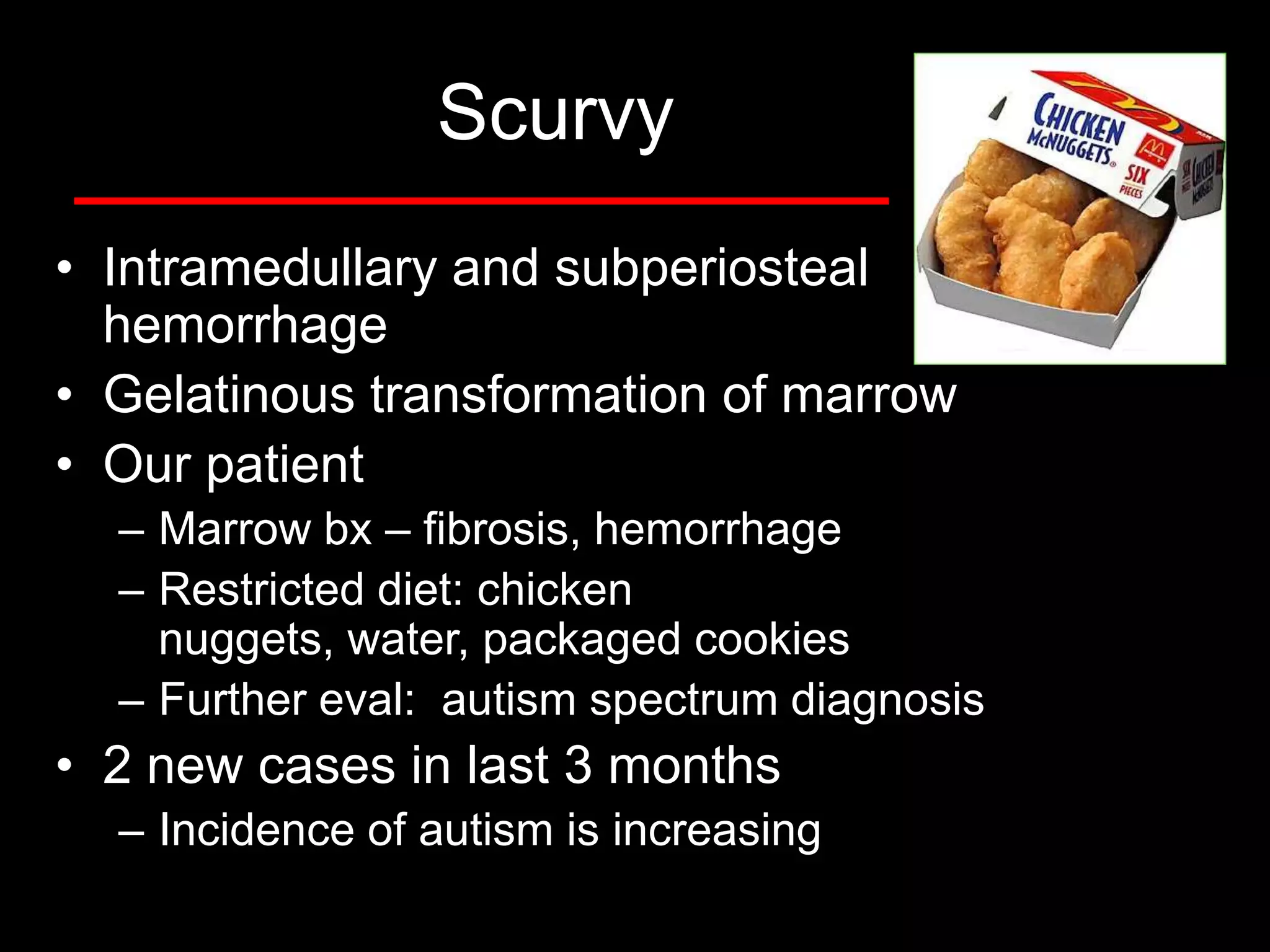 Scurvy
• Intramedullary and subperiosteal
hemorrhage
• Gelatinous transformation of marrow
• Our patient
– Marrow bx – fibrosis, hemorrhage
– Restricted diet: chicken
nuggets, water, packaged cookies
– Further eval: autism spectrum diagnosis

• 2 new cases in last 3 months
– Incidence of autism is increasing

 