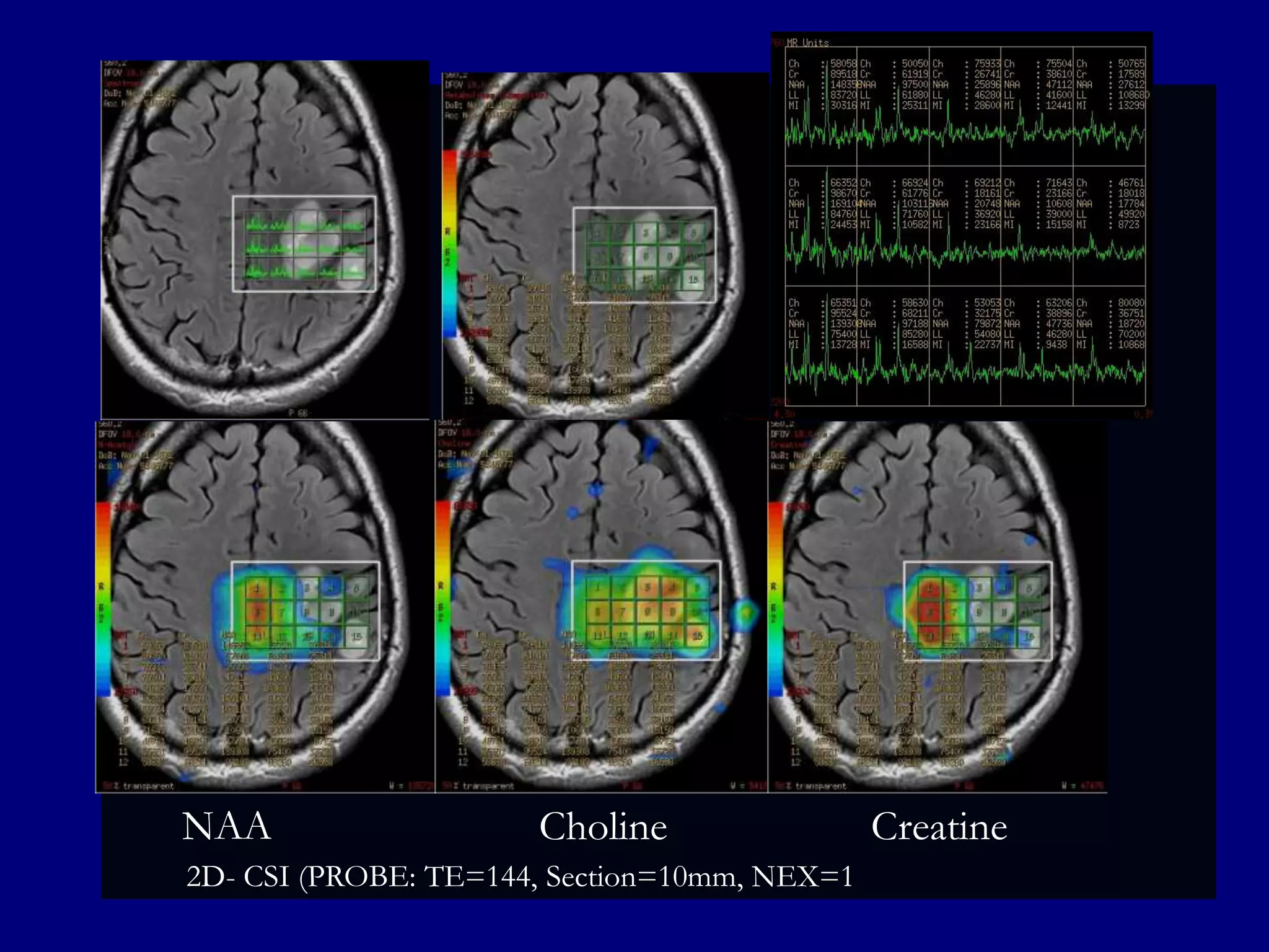 NAA

Choline

2D- CSI (PROBE: TE=144, Section=10mm, NEX=1

Creatine

 