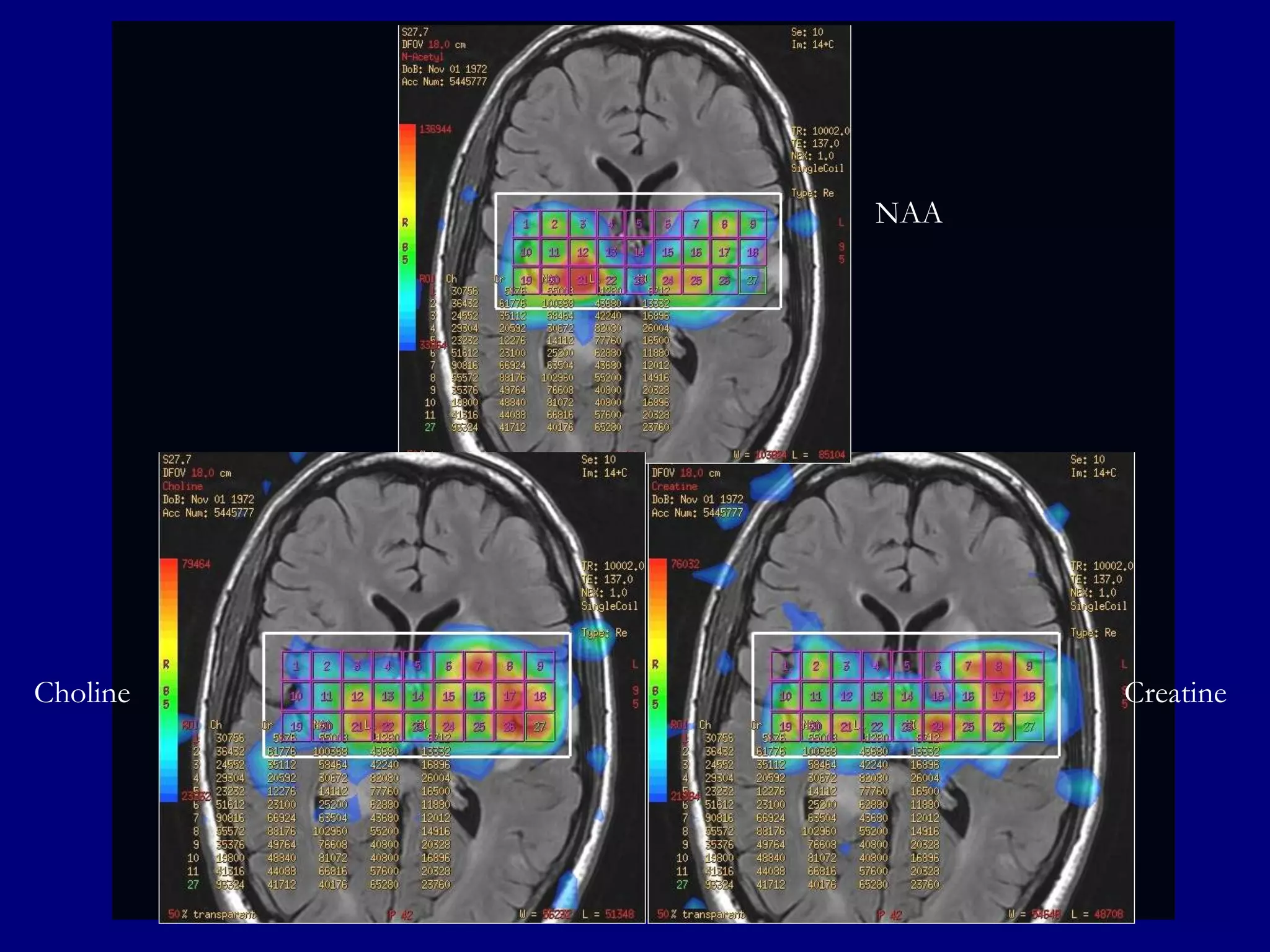 NAA

Choline

Creatine

 