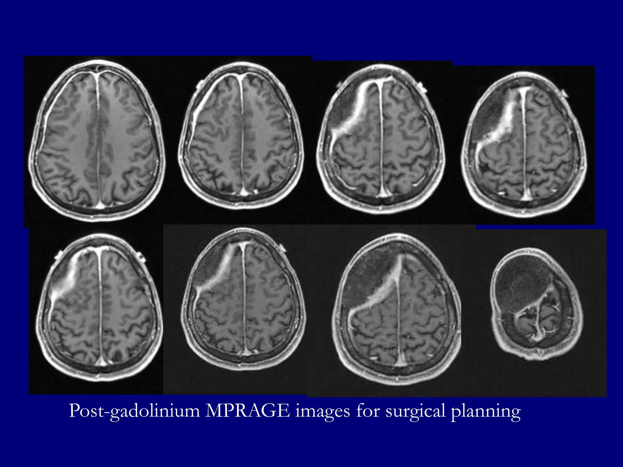 Post-gadolinium MPRAGE images for surgical planning

 
