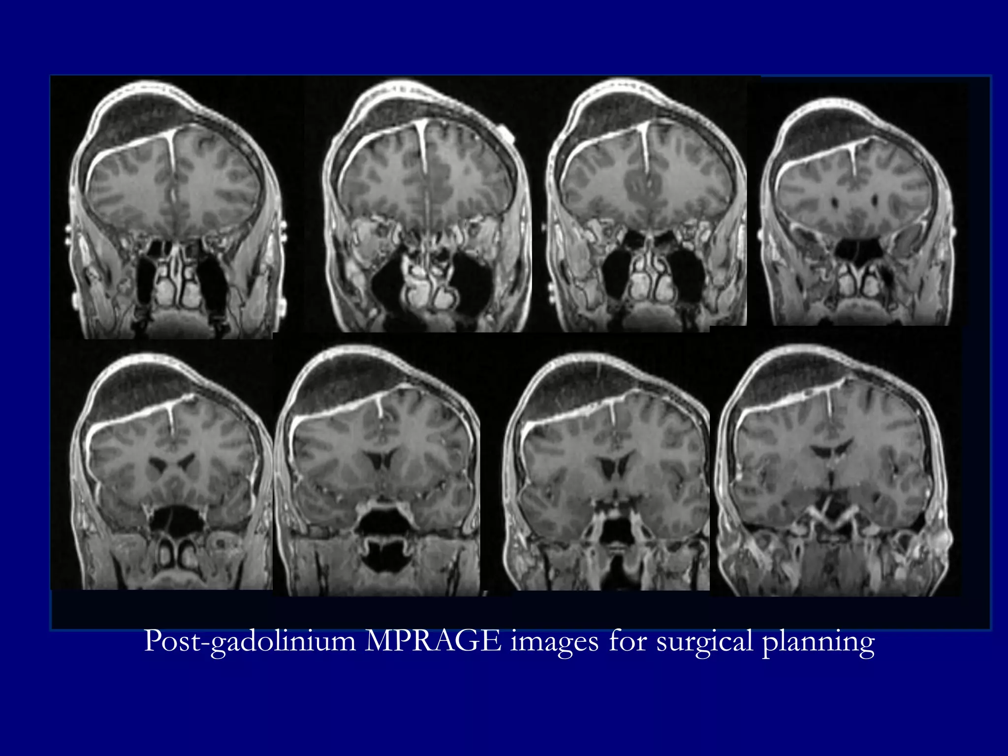 Post-gadolinium MPRAGE images for surgical planning

 