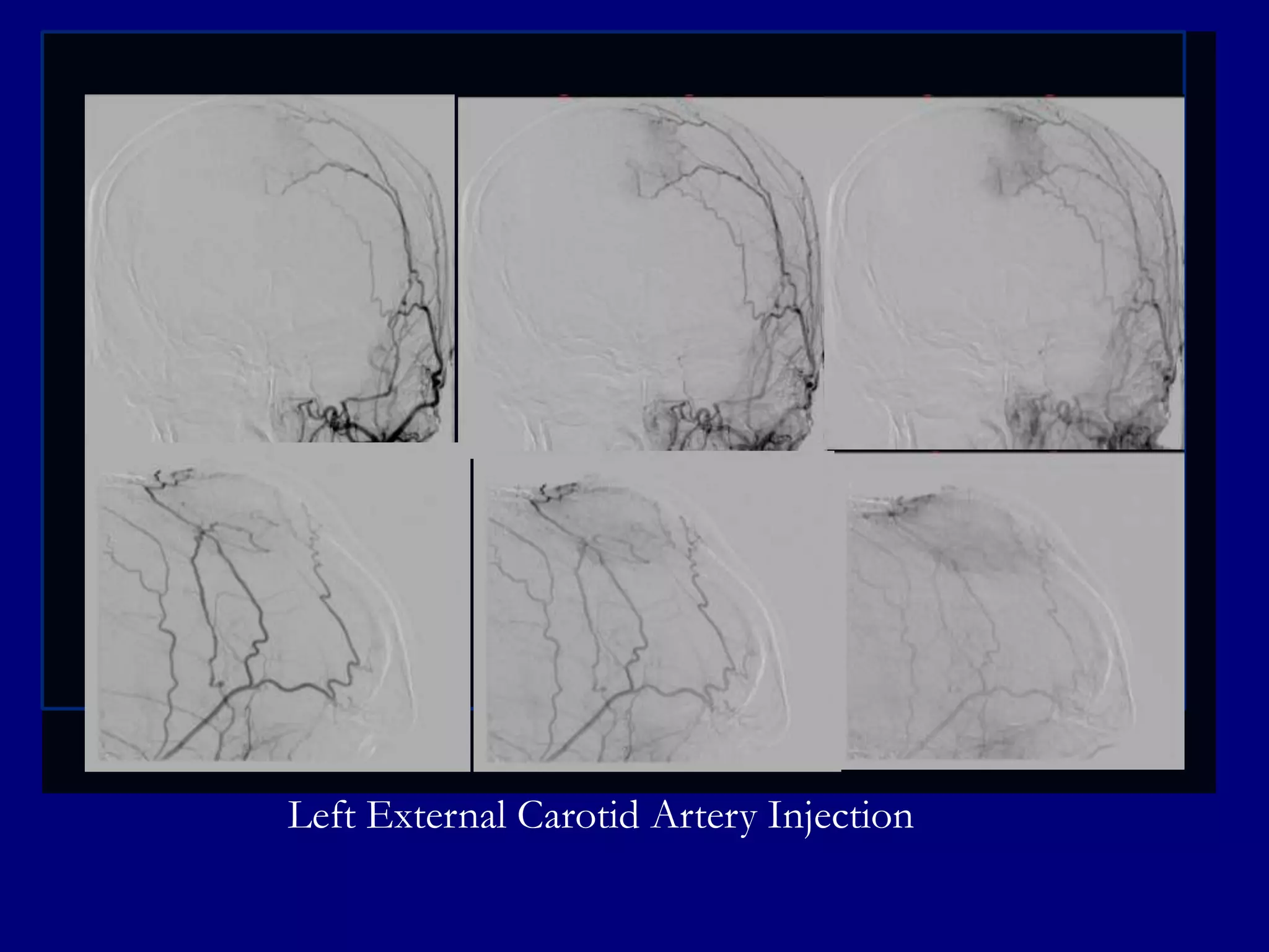 Left External Carotid Artery Injection

 