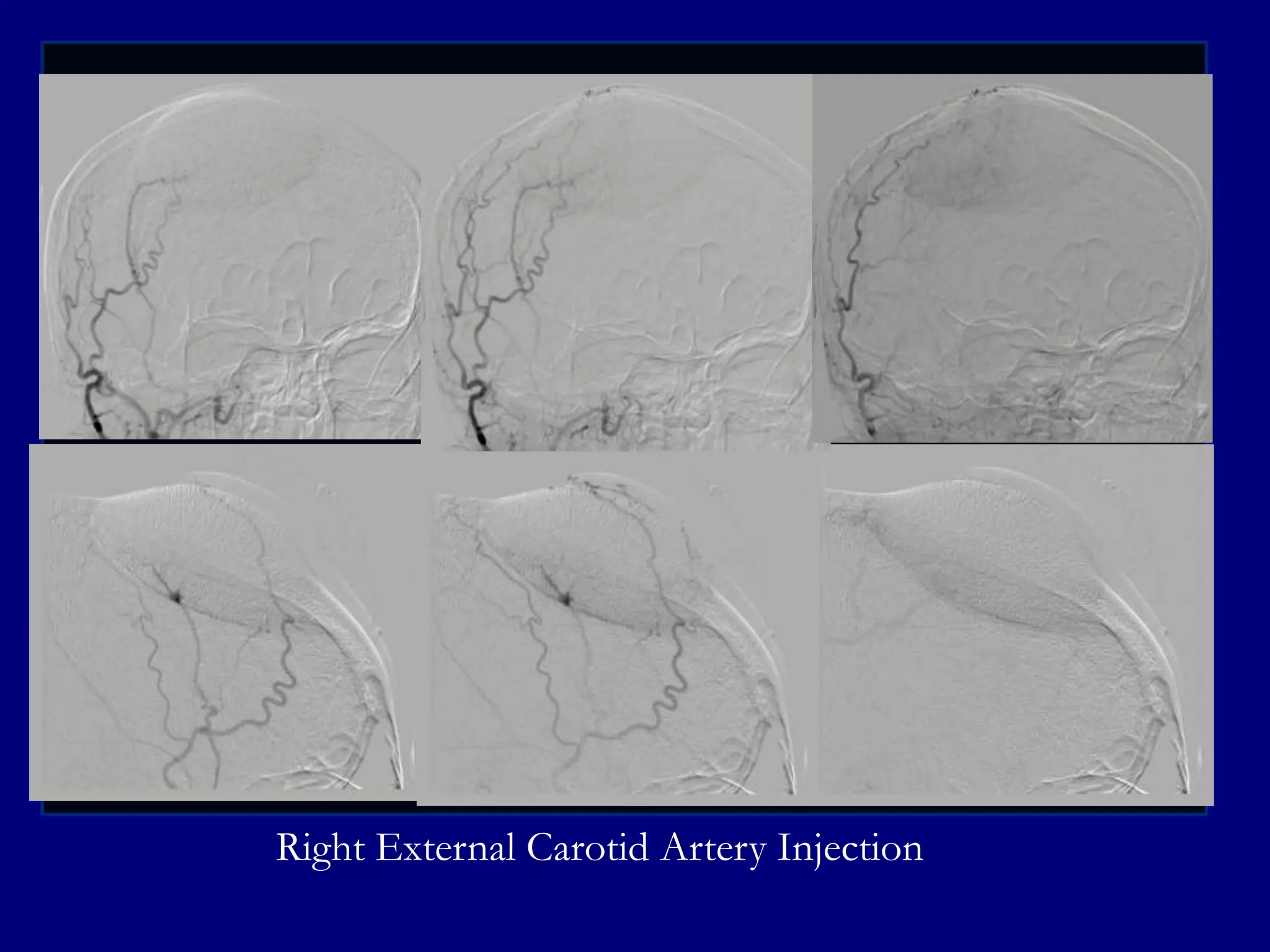 Right External Carotid Artery Injection

 