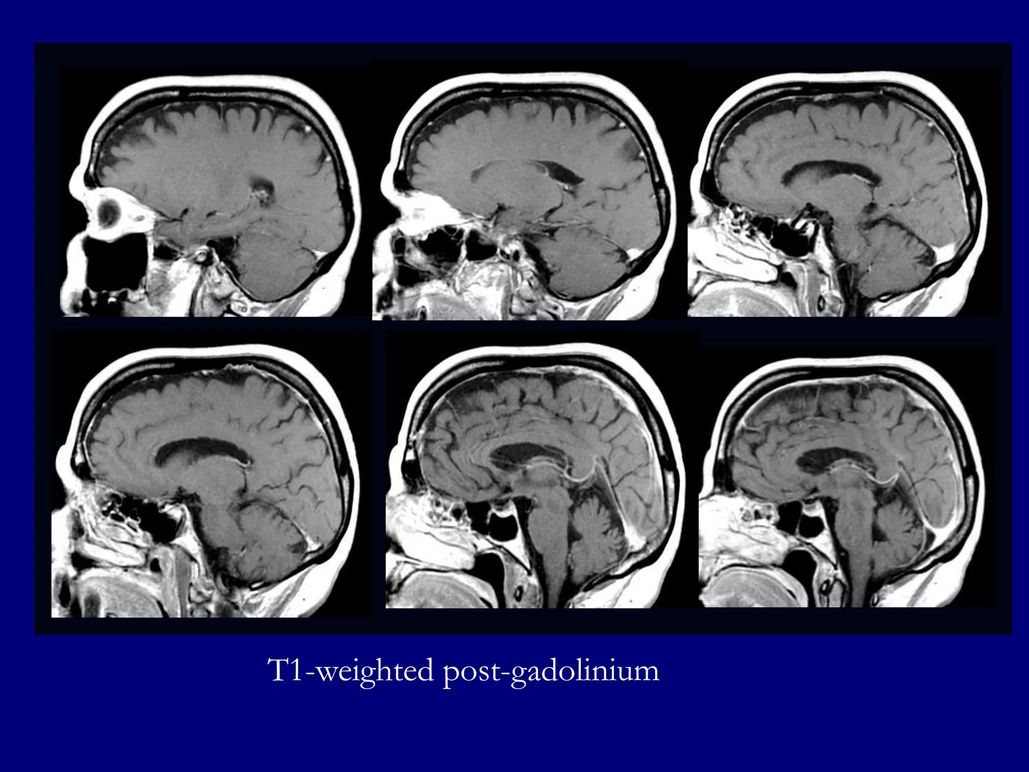 T1-weighted post-gadolinium

 