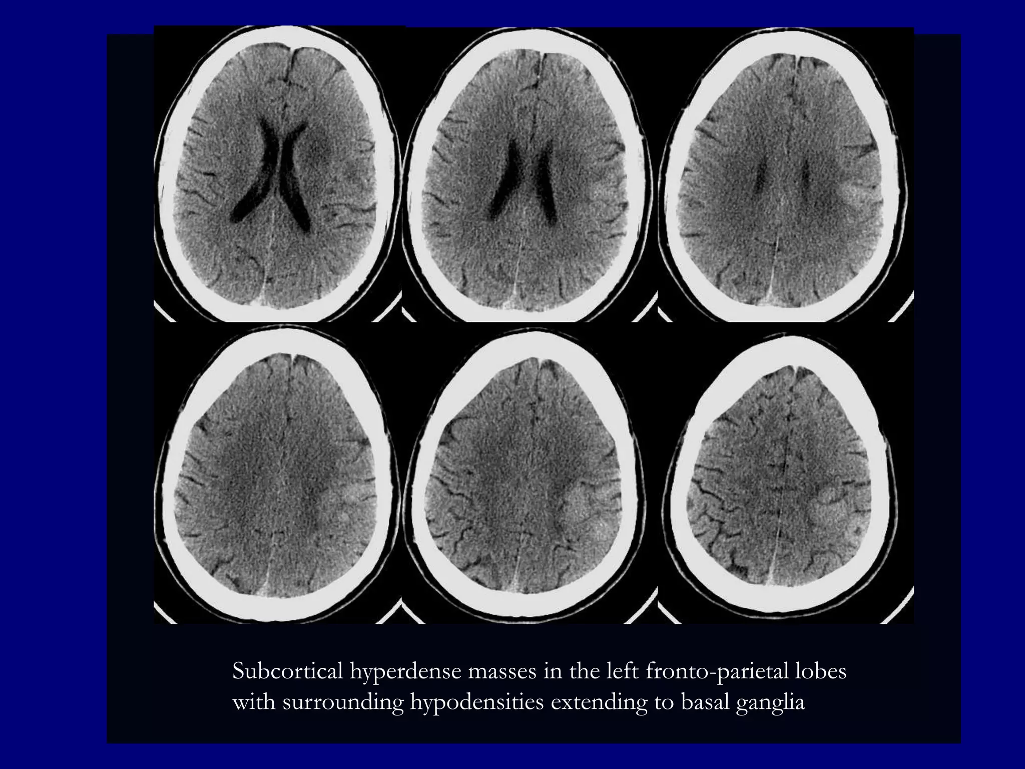 Subcortical hyperdense masses in the left fronto-parietal lobes
with surrounding hypodensities extending to basal ganglia

 