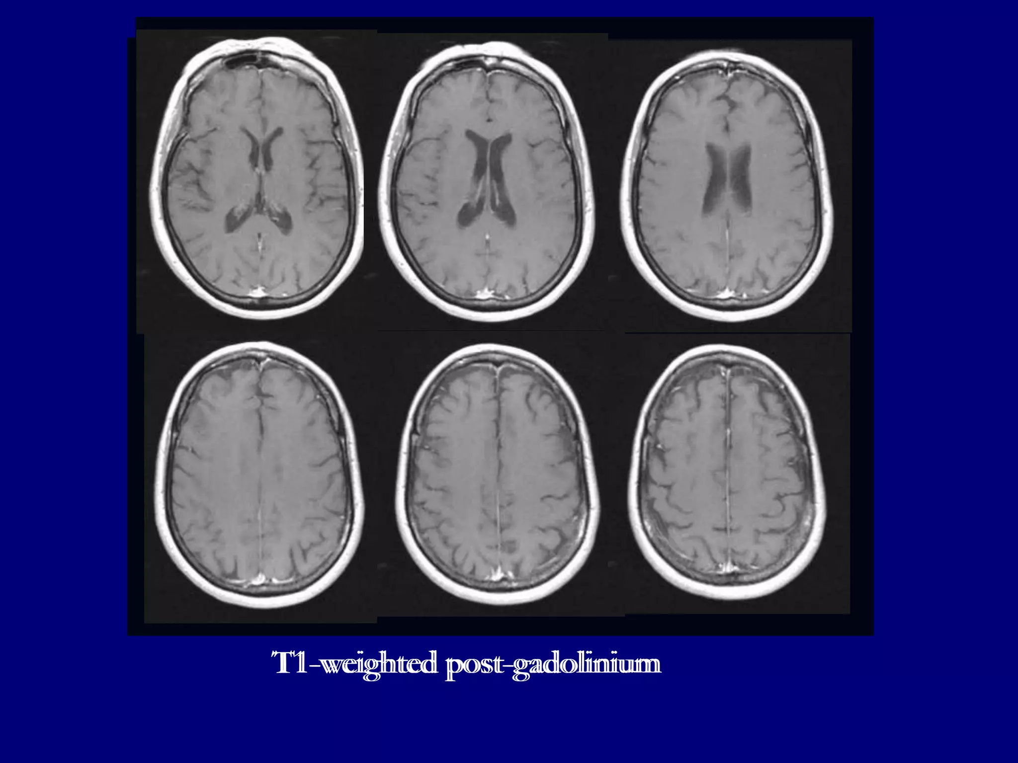 T1-weighted post-gadolinium

 