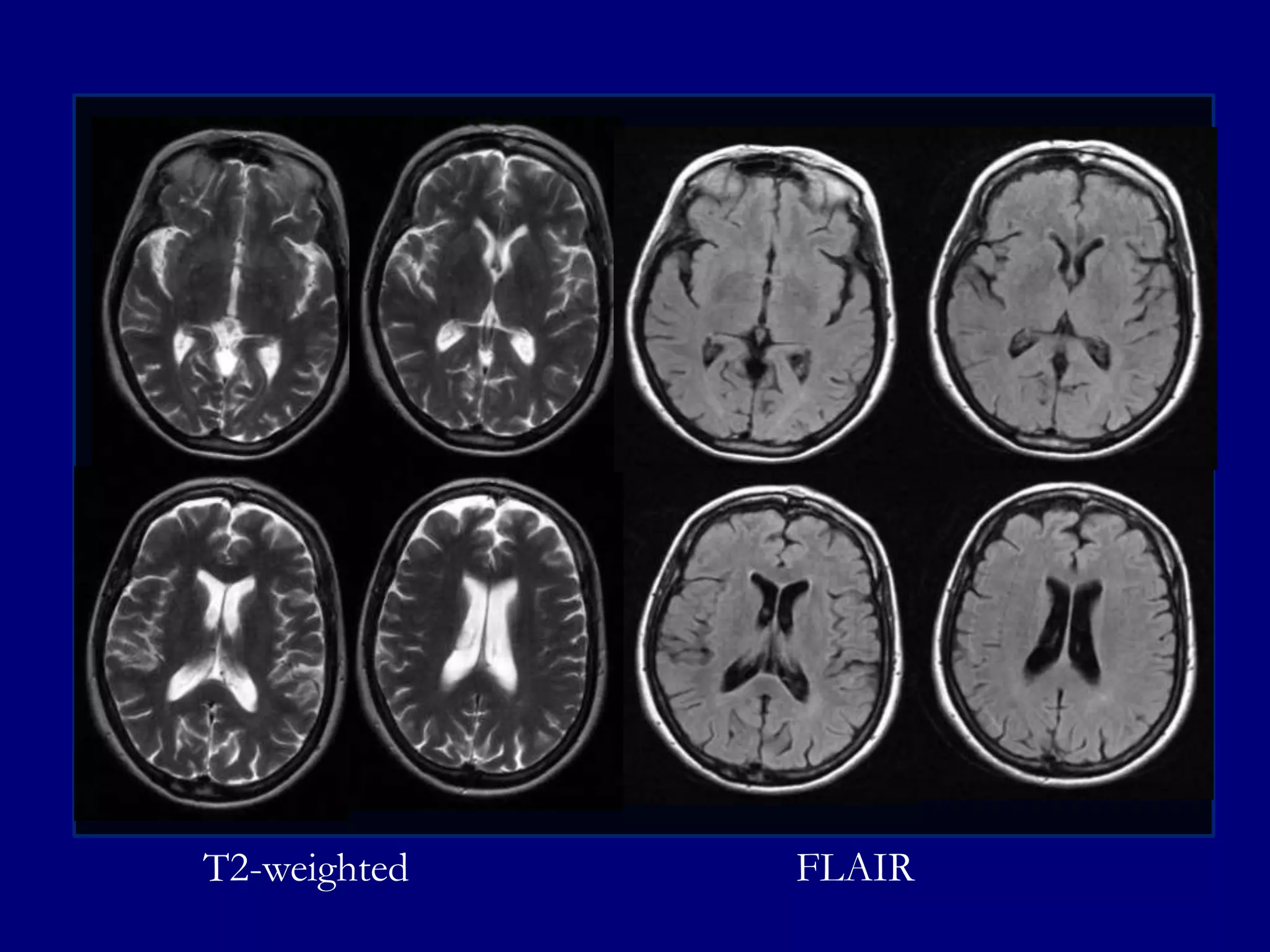 T2-weighted

FLAIR

 