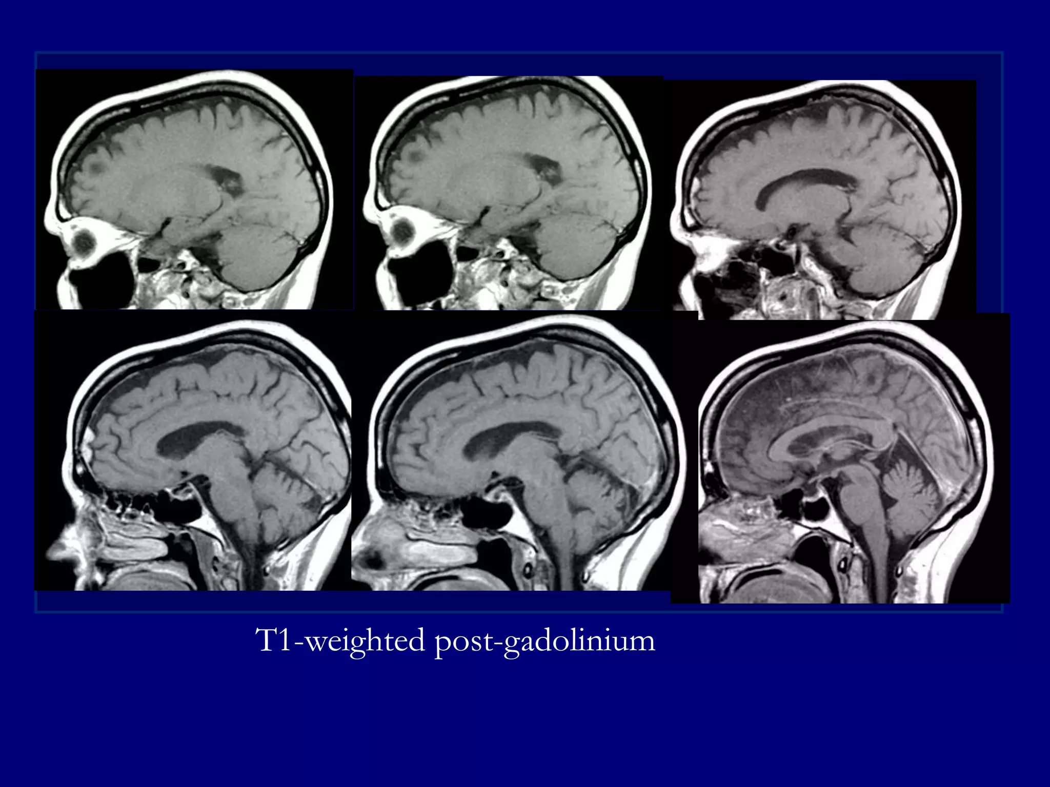T1-weighted post-gadolinium

 