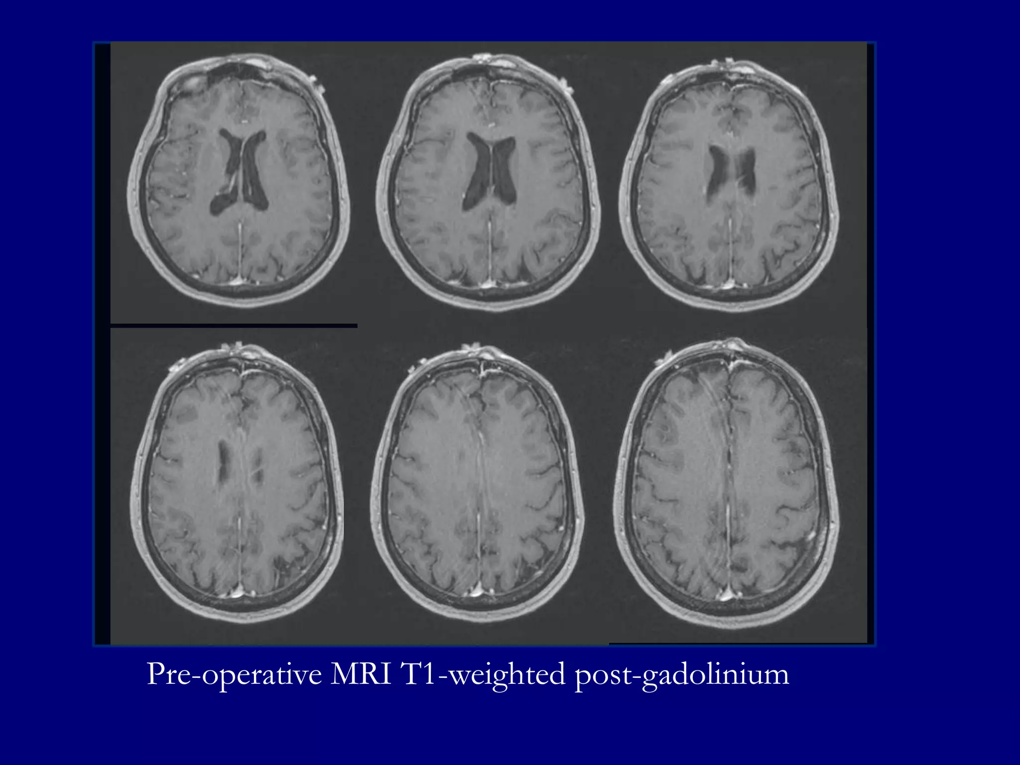 Pre-operative MRI T1-weighted post-gadolinium

 