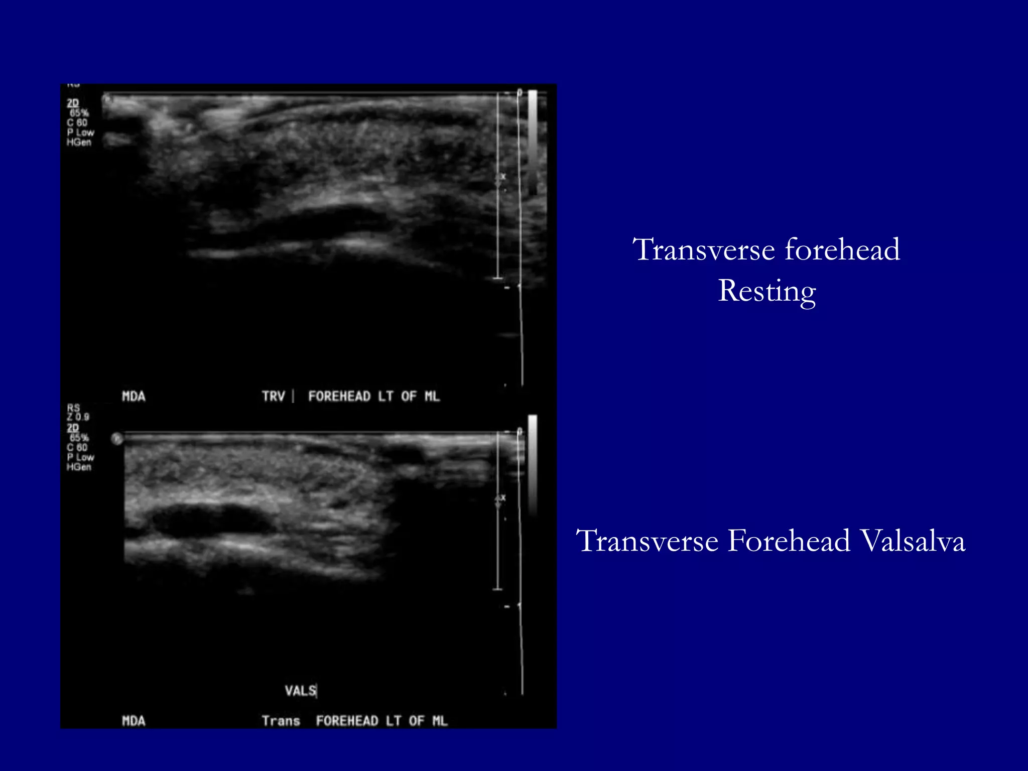 Transverse forehead
Resting

Transverse Forehead Valsalva

 