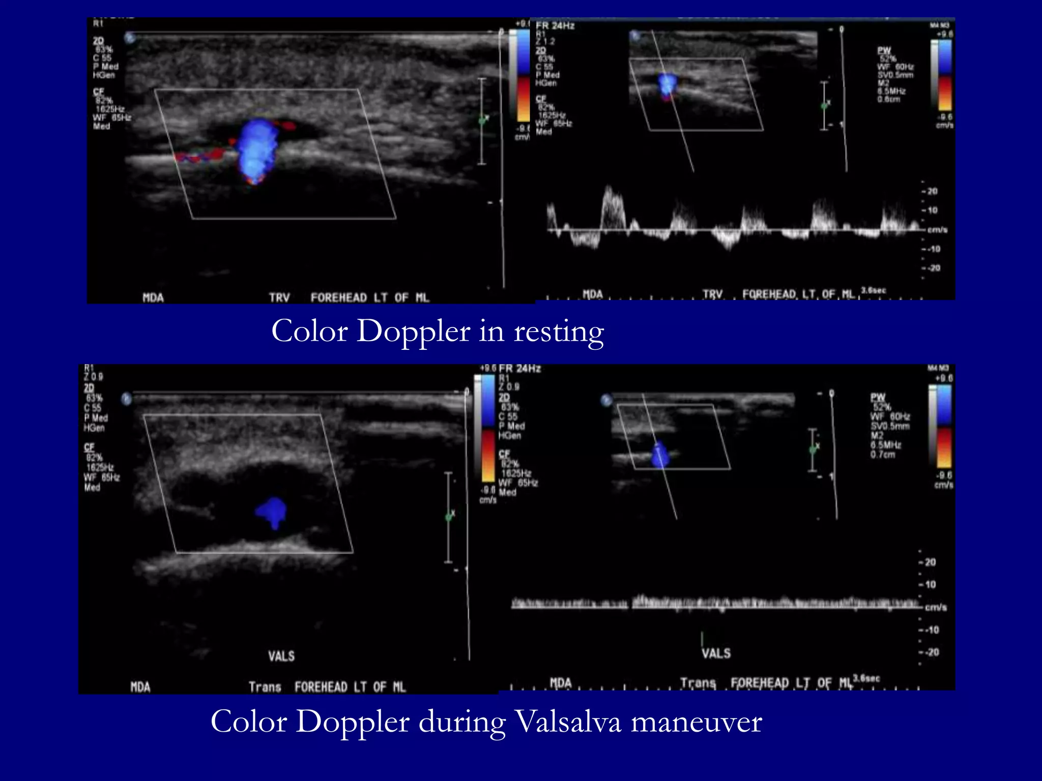 Color Doppler in resting

Color Doppler during Valsalva maneuver

 