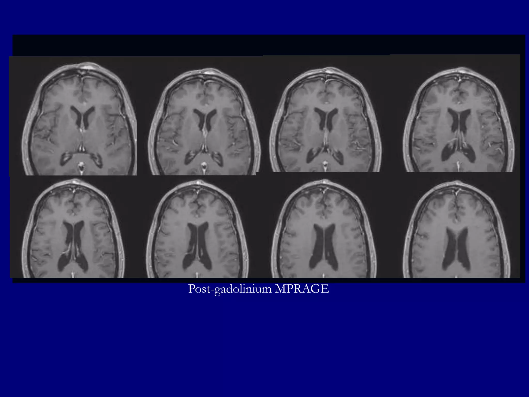 Post-gadolinium MPRAGE

 