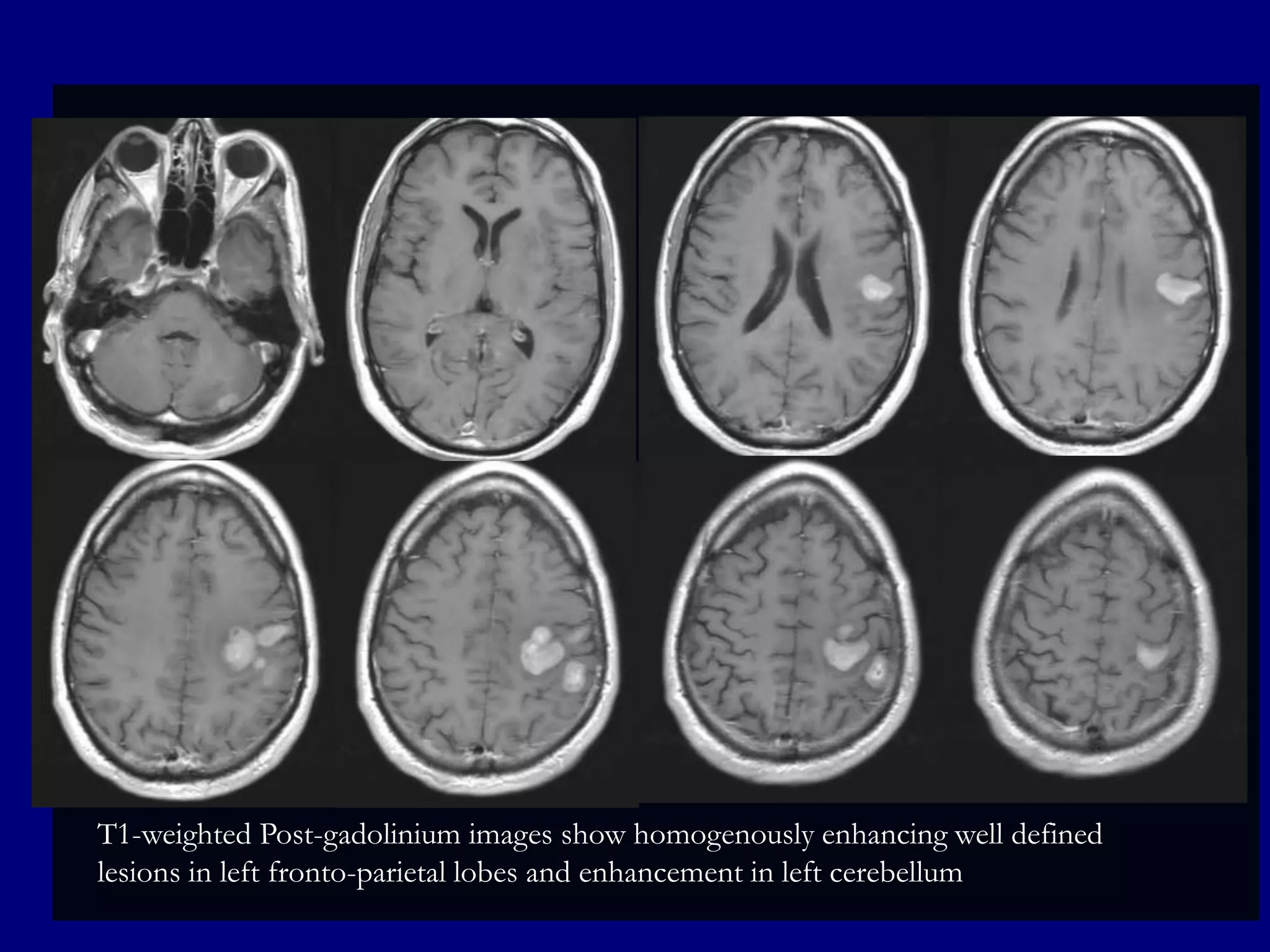 T1-weighted Post-gadolinium images show homogenously enhancing well defined
lesions in left fronto-parietal lobes and enhancement in left cerebellum

 