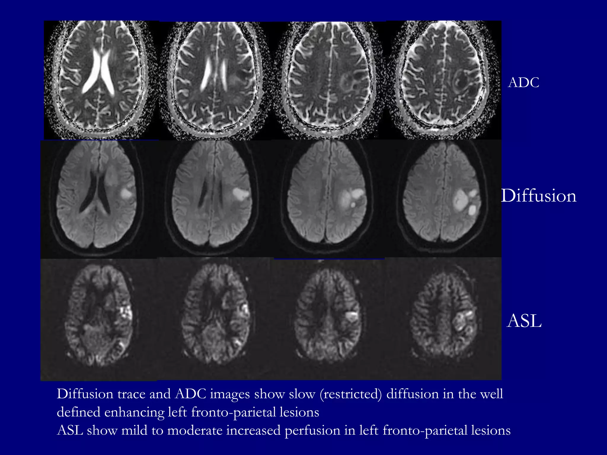 ADC

Diffusion

ASL

Diffusion trace and ADC images show slow (restricted) diffusion in the well
defined enhancing left fronto-parietal lesions
ASL show mild to moderate increased perfusion in left fronto-parietal lesions

 