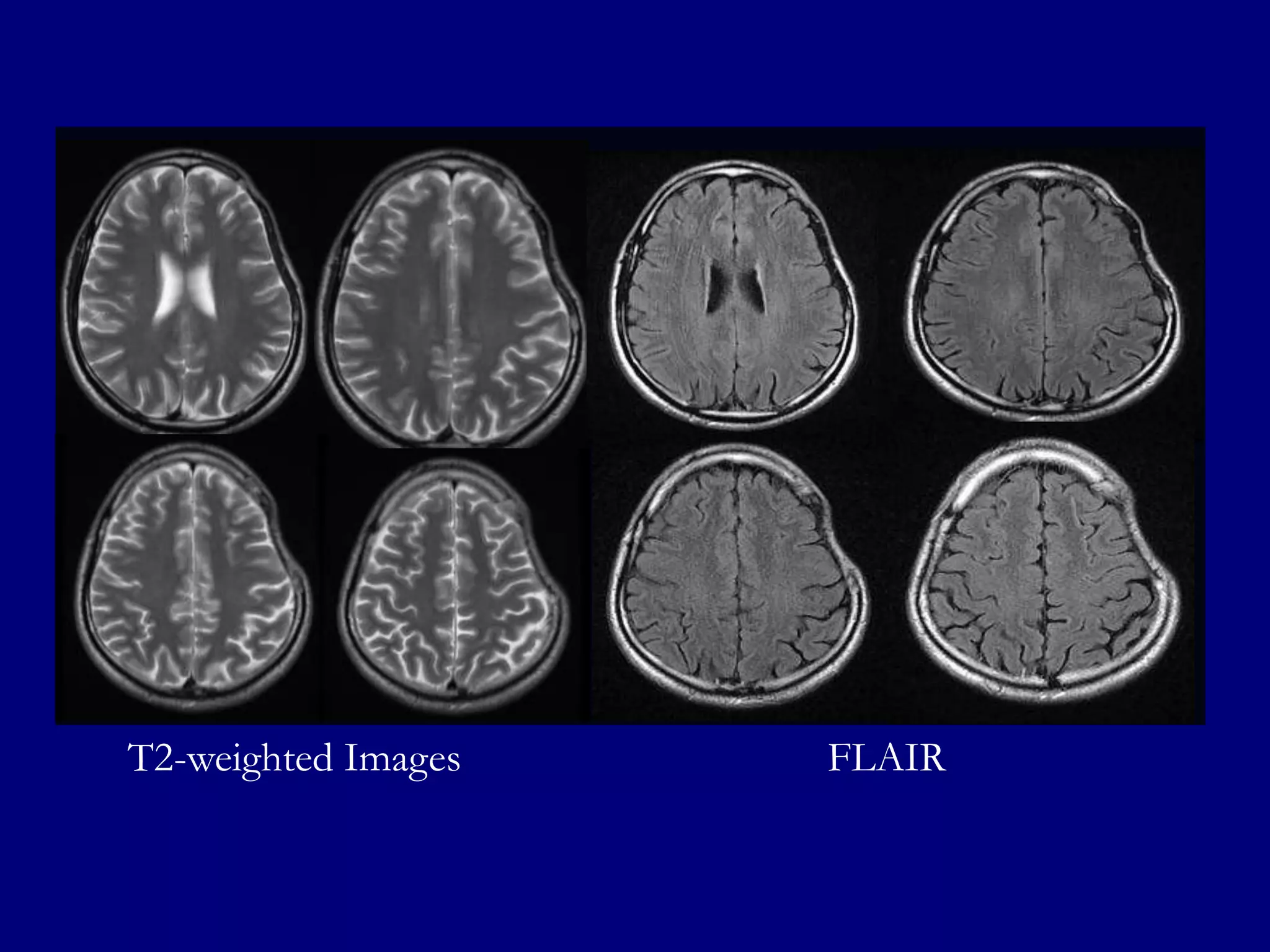 T2-weighted Images

FLAIR

 
