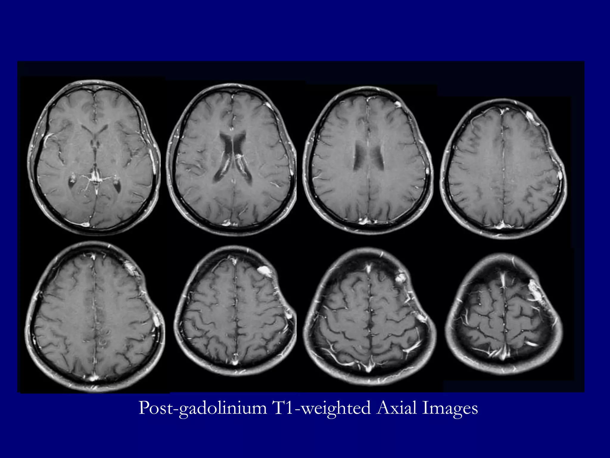 Post-gadolinium T1-weighted Axial Images

 