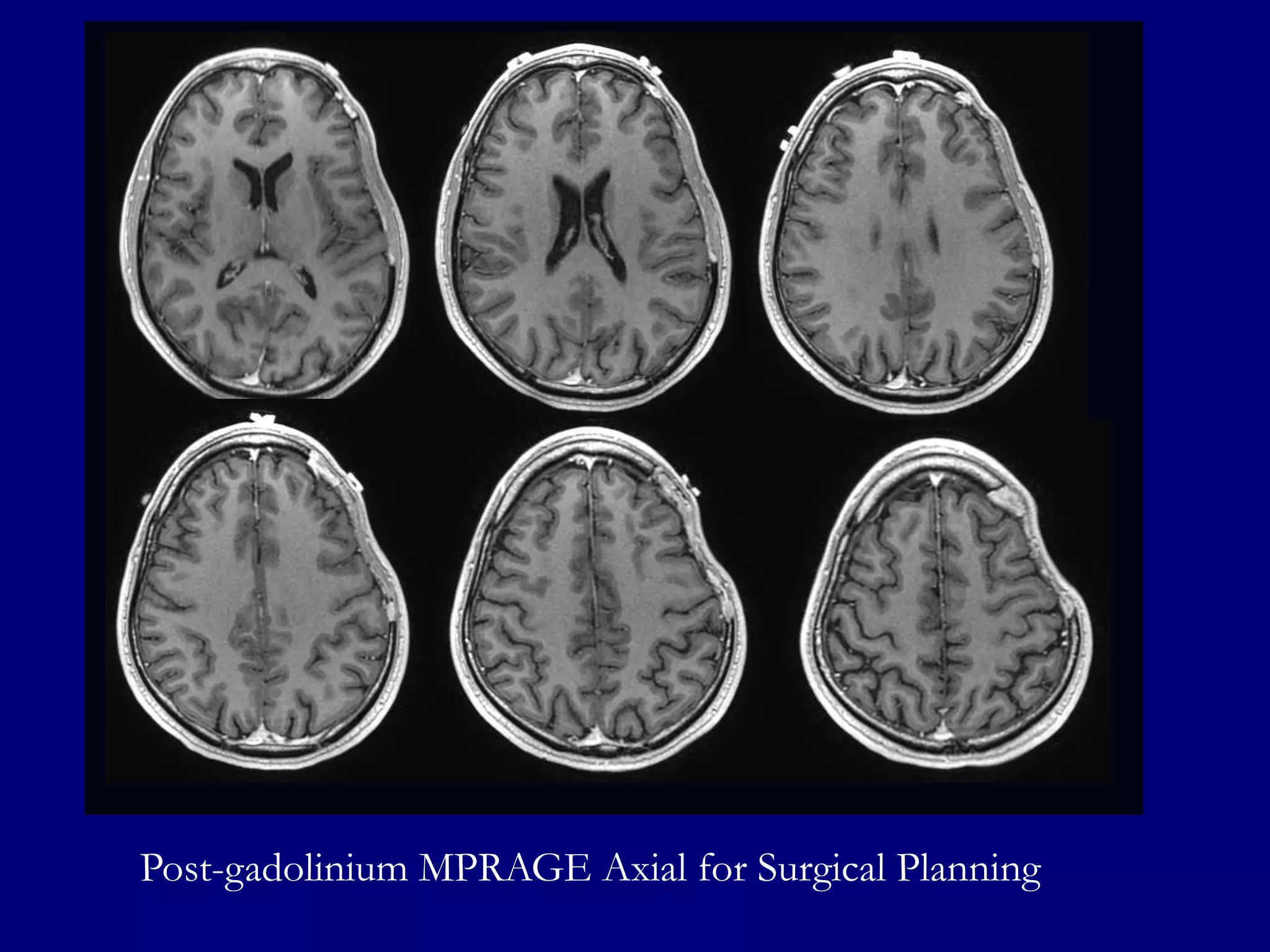 Post-gadolinium MPRAGE Axial for Surgical Planning

 