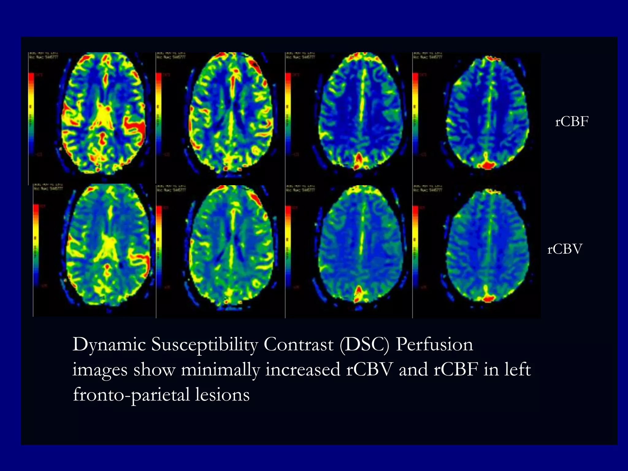 rCBF

rCBV

Dynamic Susceptibility Contrast (DSC) Perfusion
images show minimally increased rCBV and rCBF in left
fronto-parietal lesions

 