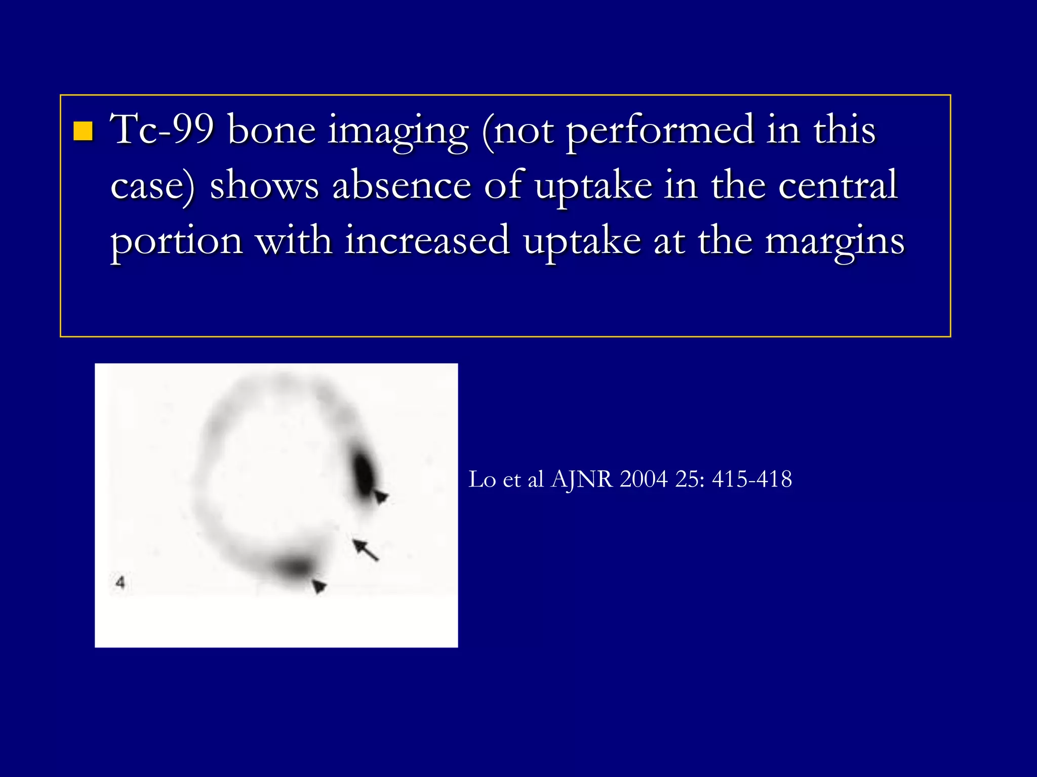

Tc-99 bone imaging (not performed in this
case) shows absence of uptake in the central
portion with increased uptake at the margins

Lo et al AJNR 2004 25: 415-418

 
