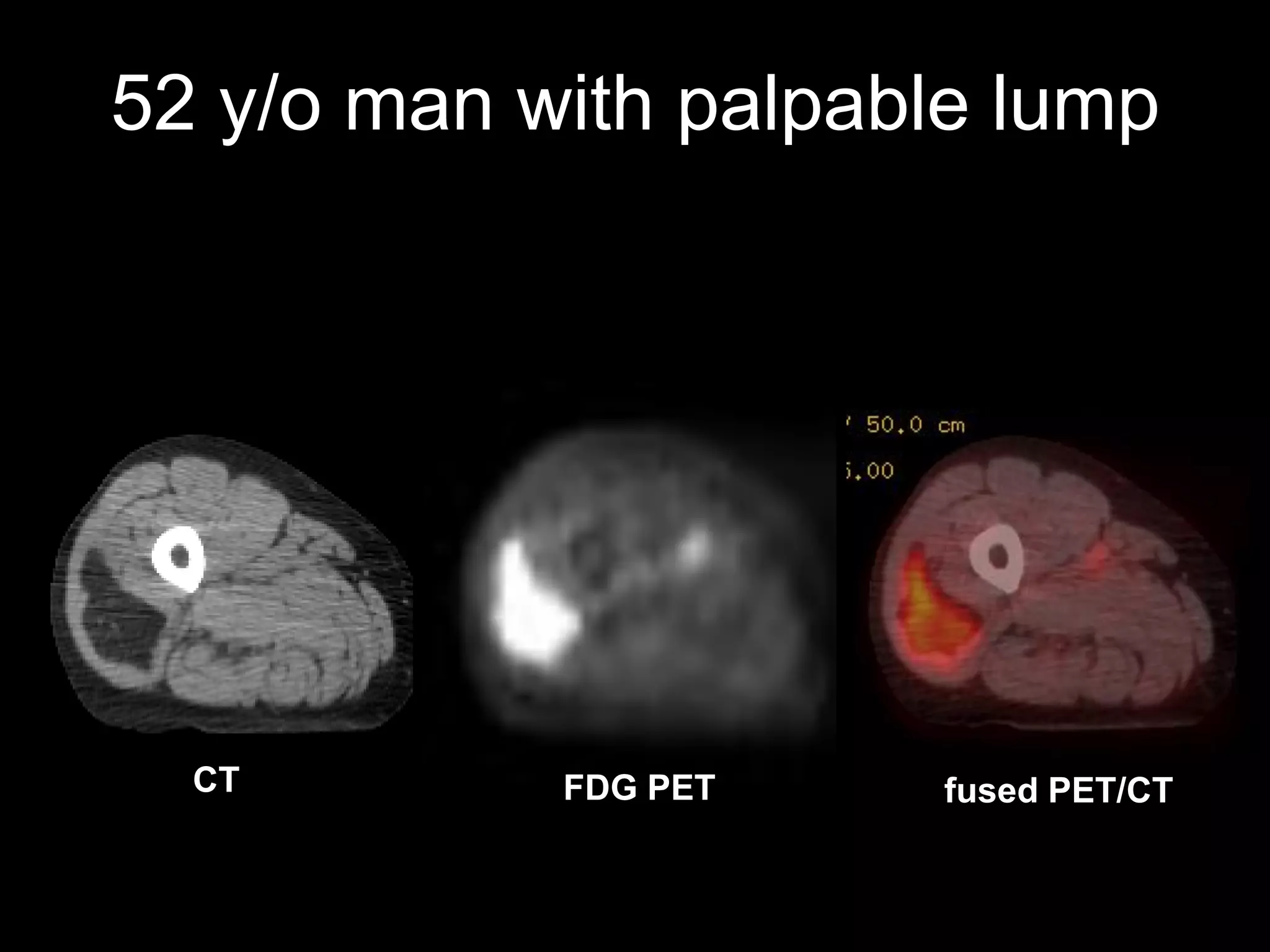52 y/o man with palpable lump 
CT 
FDG PET 
fused PET/CT  
