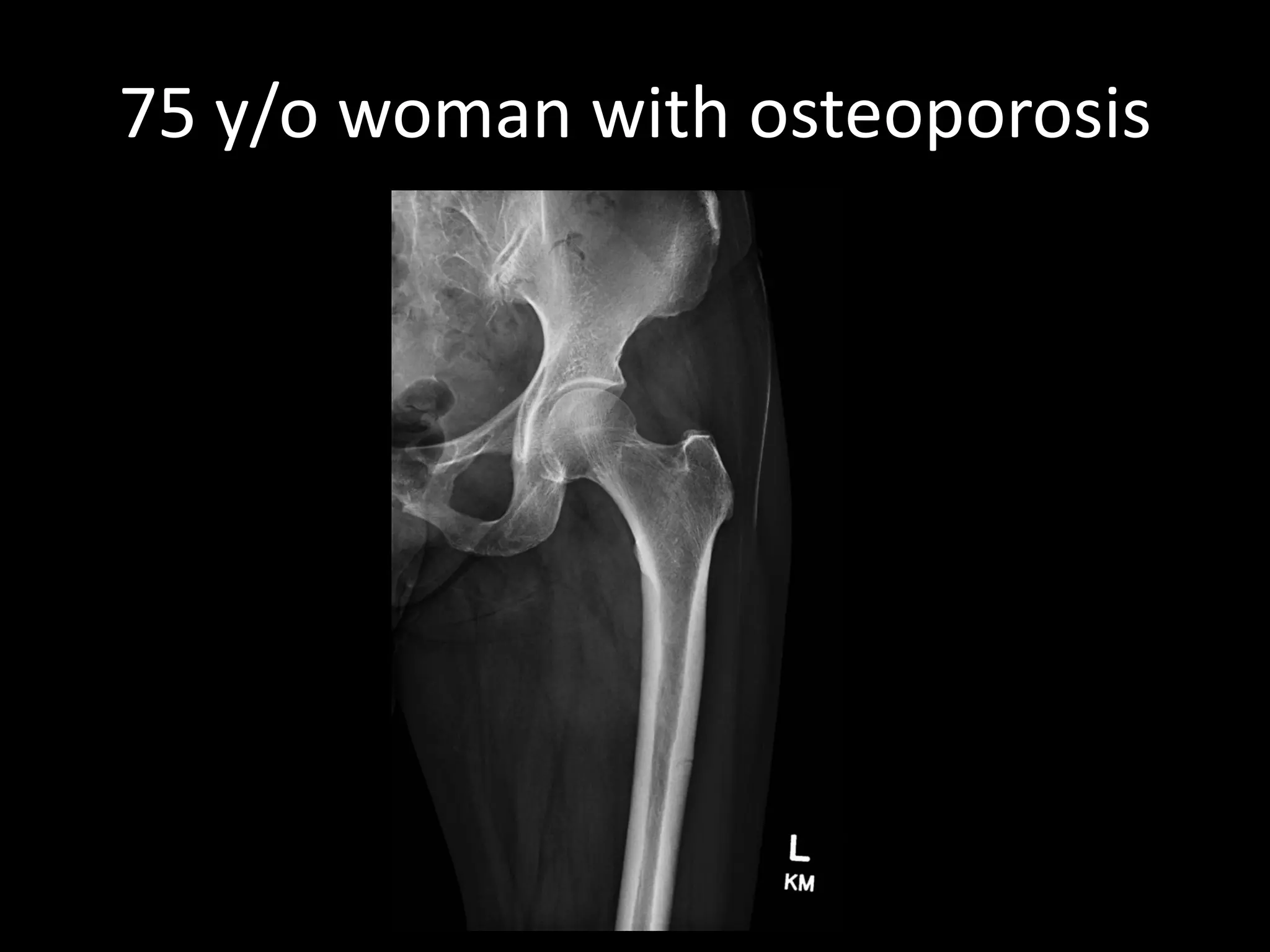 75 y/o woman with osteoporosis  