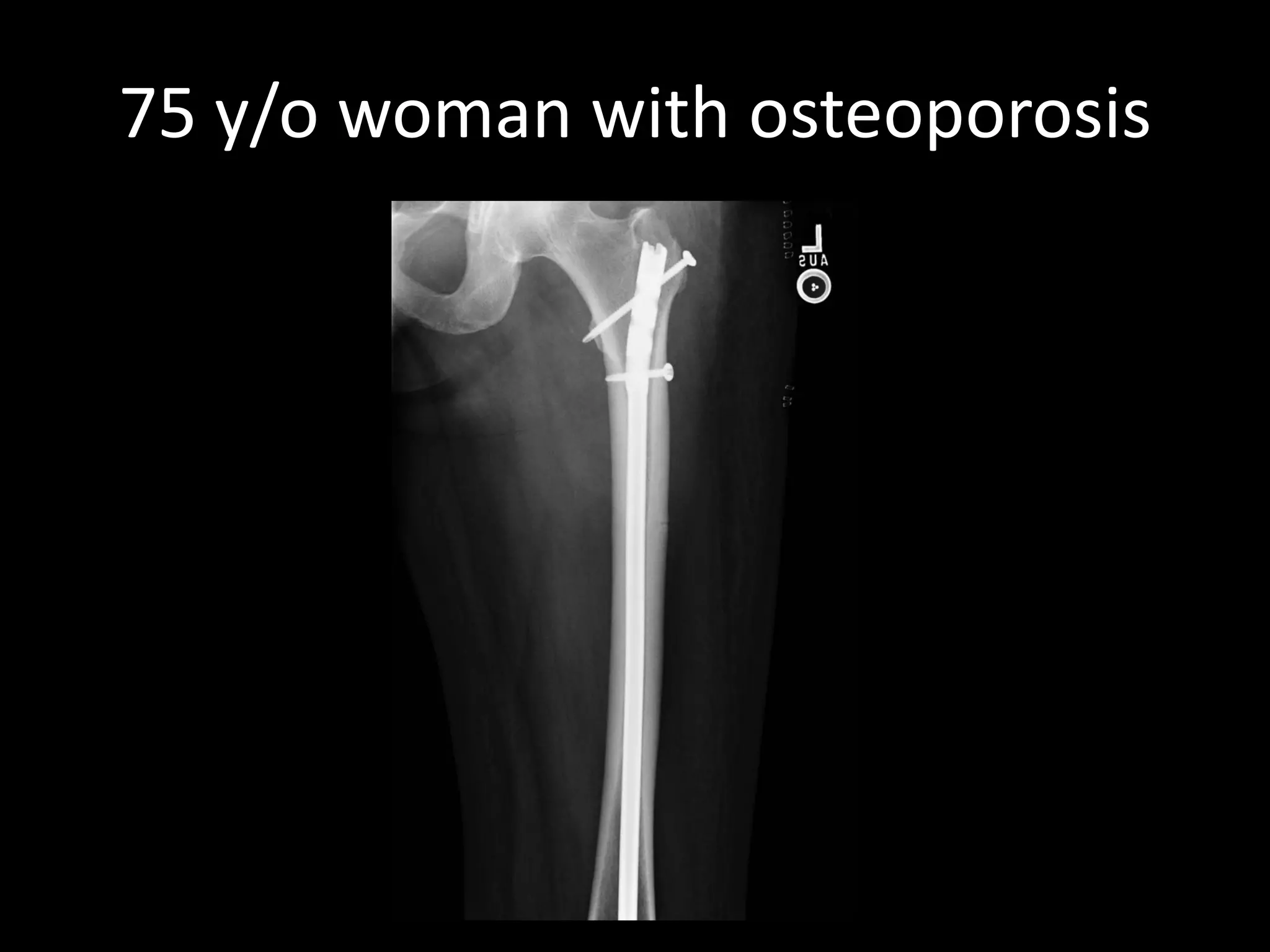 75 y/o woman with osteoporosis  