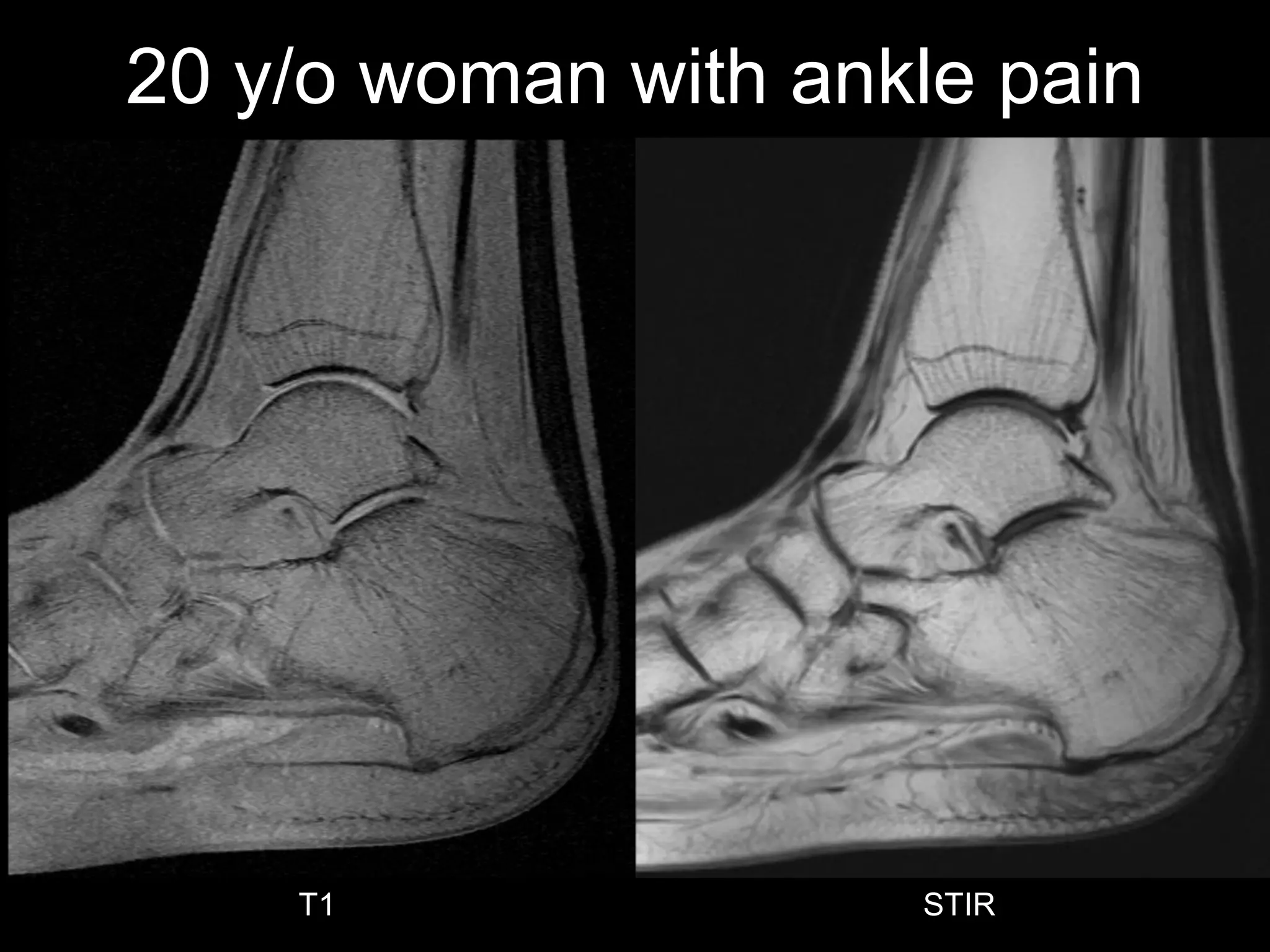 sag T1 
20 y/o woman with ankle pain 
T1 
STIR  
