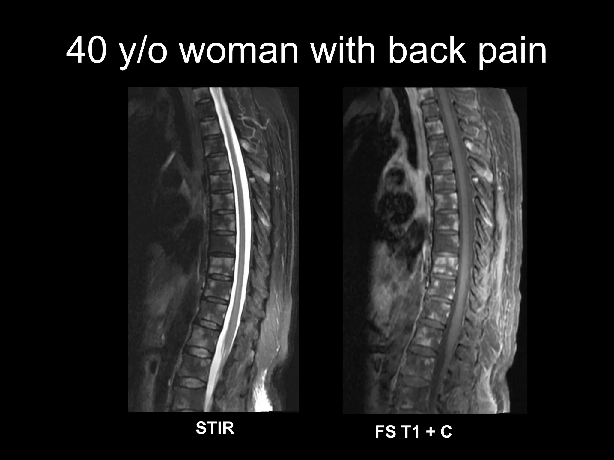 40 y/o woman with back pain 
STIR 
FS T1 + C  