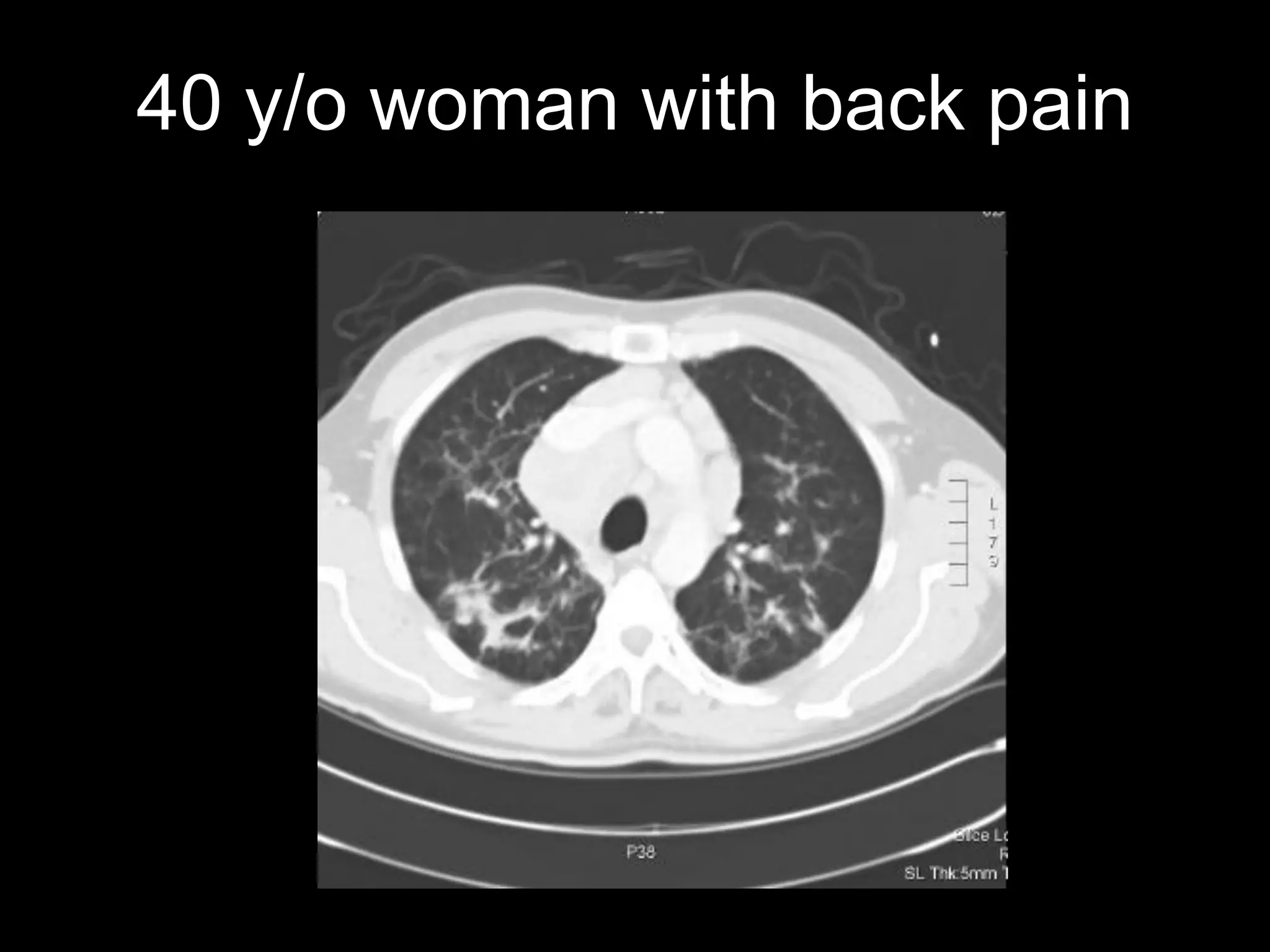 40 y/o woman with back pain  