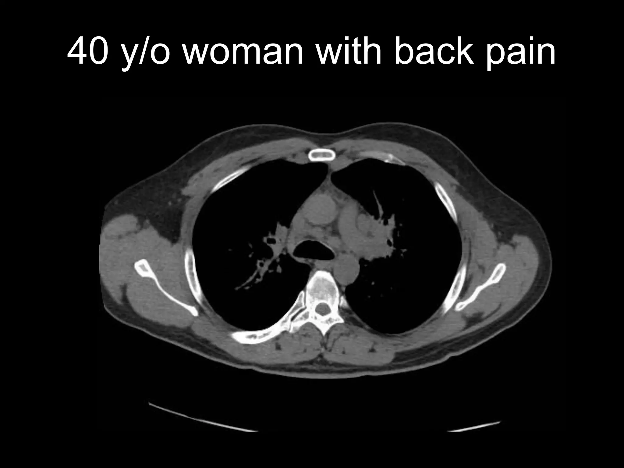 40 y/o woman with back pain  
