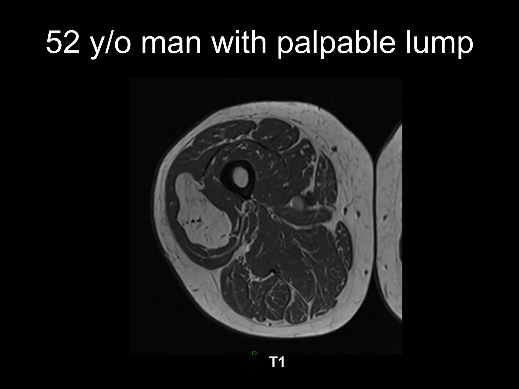 52 y/o man with palpable lump 
T1  