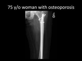 75 y/o woman with osteoporosis 
 
