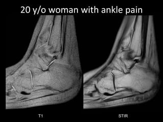 20 y/o woman with ankle pain 
T1 STIR 
