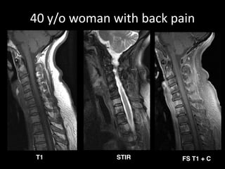 40 y/o woman with back pain 
T1 STIR FS T1 + C 
 