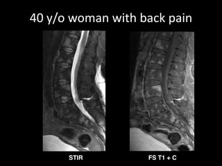 40 y/o woman with back pain 
STIR FS T1 + C 
 