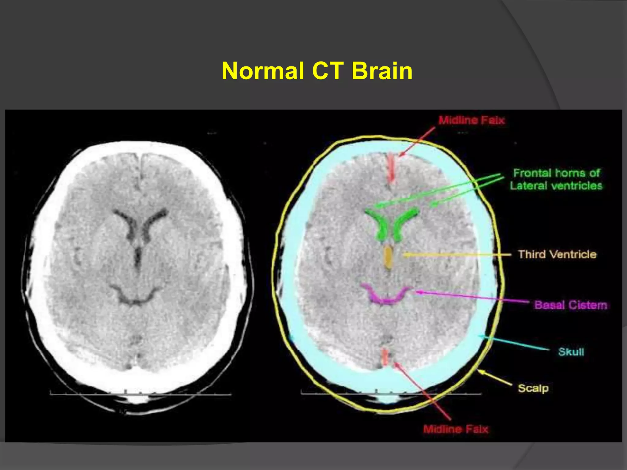 Normal CT Brain

 