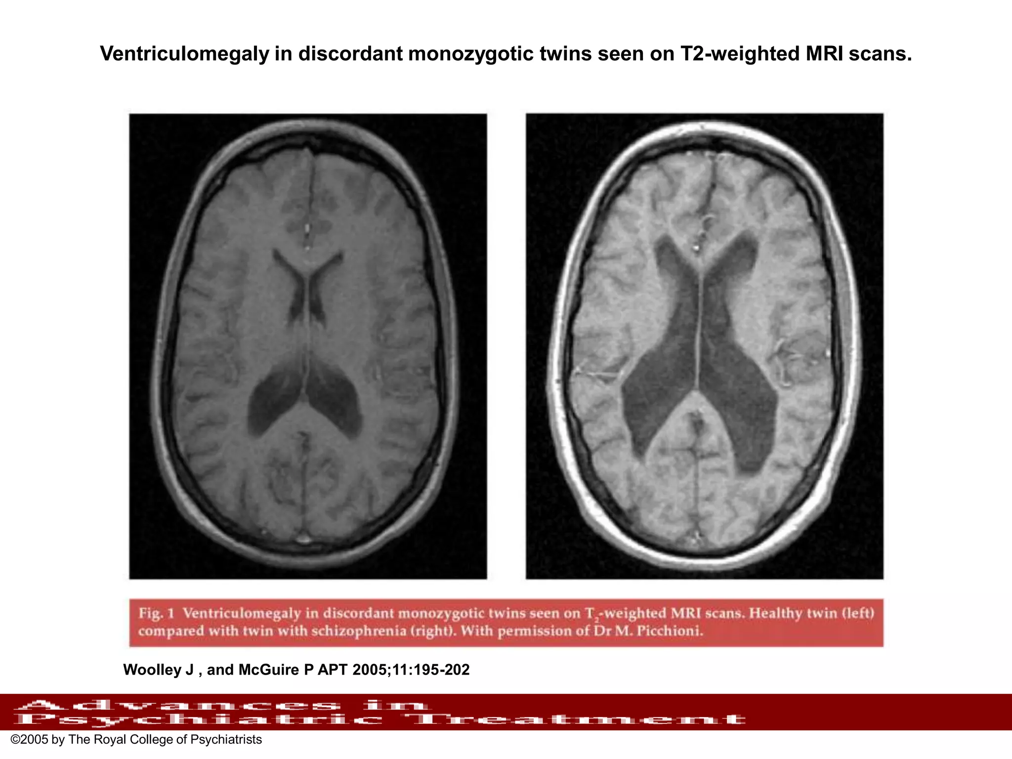 Ventriculomegaly in discordant monozygotic twins seen on T2-weighted MRI scans.

Woolley J , and McGuire P APT 2005;11:195-202

©2005 by The Royal College of Psychiatrists

 
