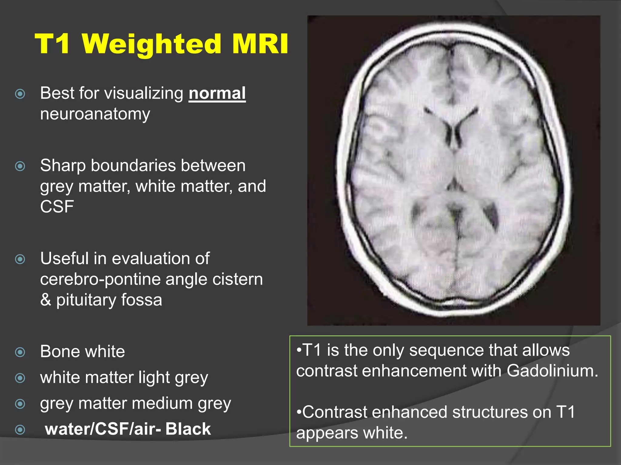 T1 Weighted MRI


Best for visualizing normal
neuroanatomy



Sharp boundaries between
grey matter, white matter, and
CSF



Useful in evaluation of
cerebro-pontine angle cistern
& pituitary fossa



Bone white
white matter light grey
grey matter medium grey
water/CSF/air- Black






•T1 is the only sequence that allows
contrast enhancement with Gadolinium.
•Contrast enhanced structures on T1
appears white.

 